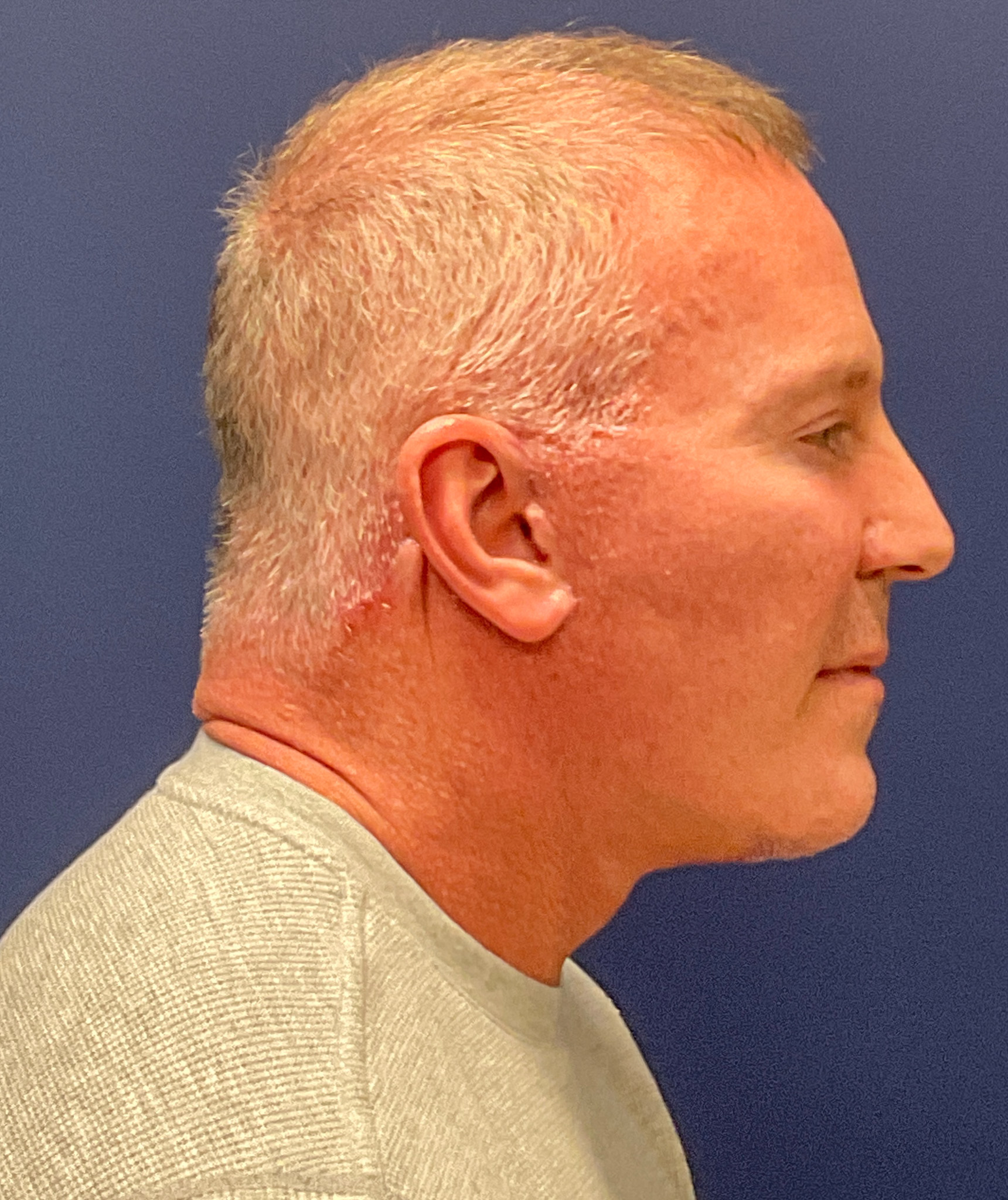 Facelift-Necklift-Blepharoplasty-Case--5535 | After Eyelid Surgery 3