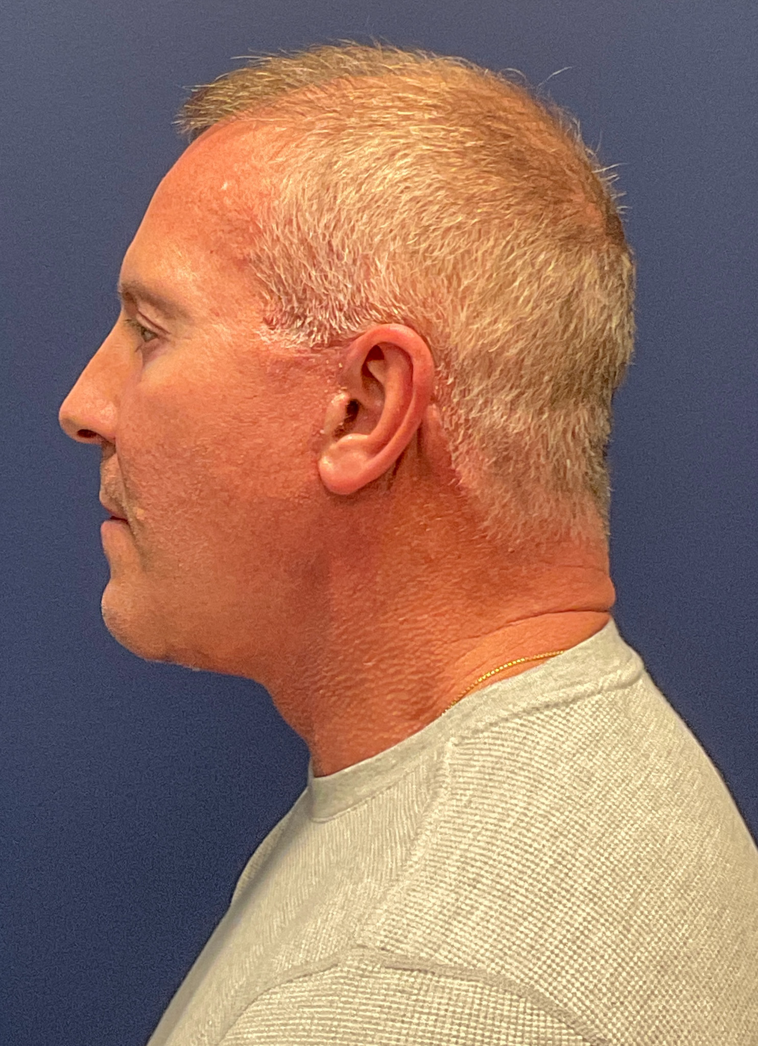 Facelift-Necklift-Blepharoplasty-Case--5535 | After Dr. Arjun Kanuri 2