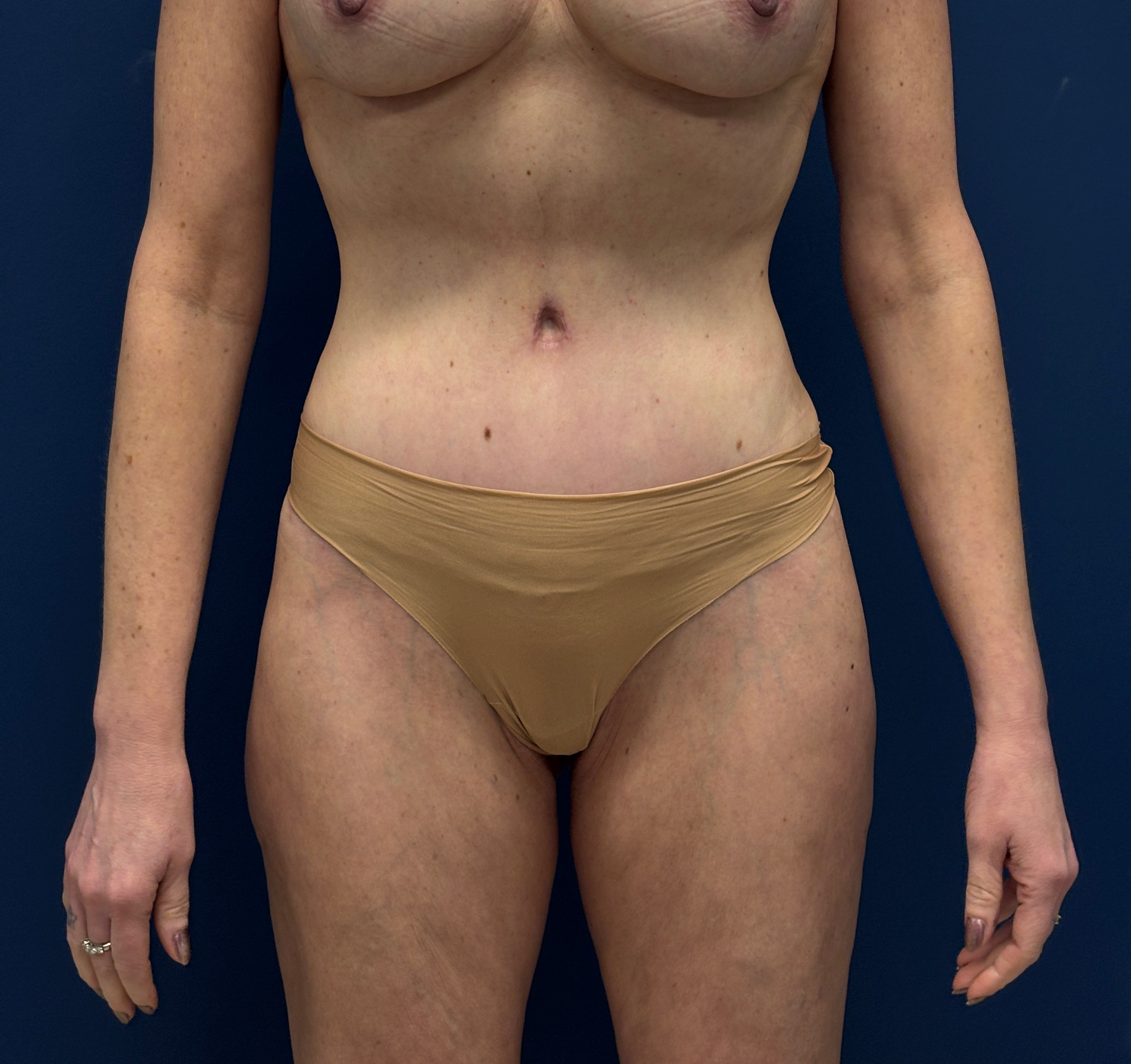 Liposuction-Case--3054 | After Dr. Frank Albino 1