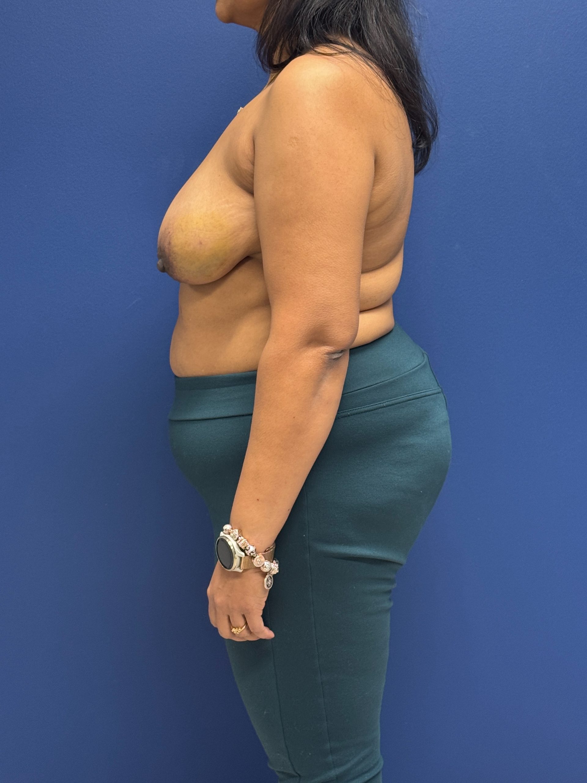 Left-Oncoplastic-Right-Reduction-Breast-Reconstruction-Case--9659 | Before Dr. Samir Rao 2