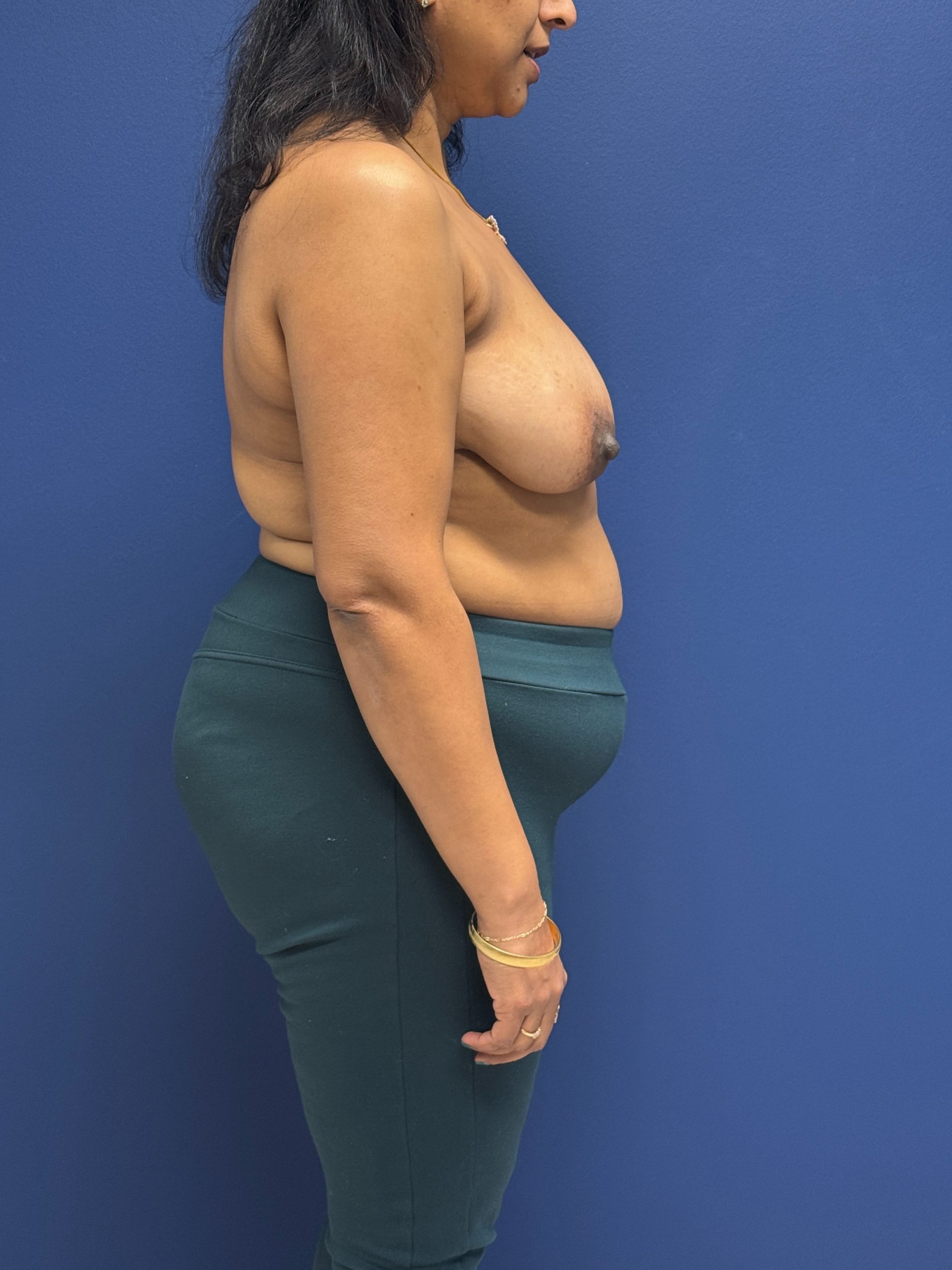 Left-Oncoplastic-Right-Reduction-Breast-Reconstruction-Case--9659 | Before Breast Reconstruction 3