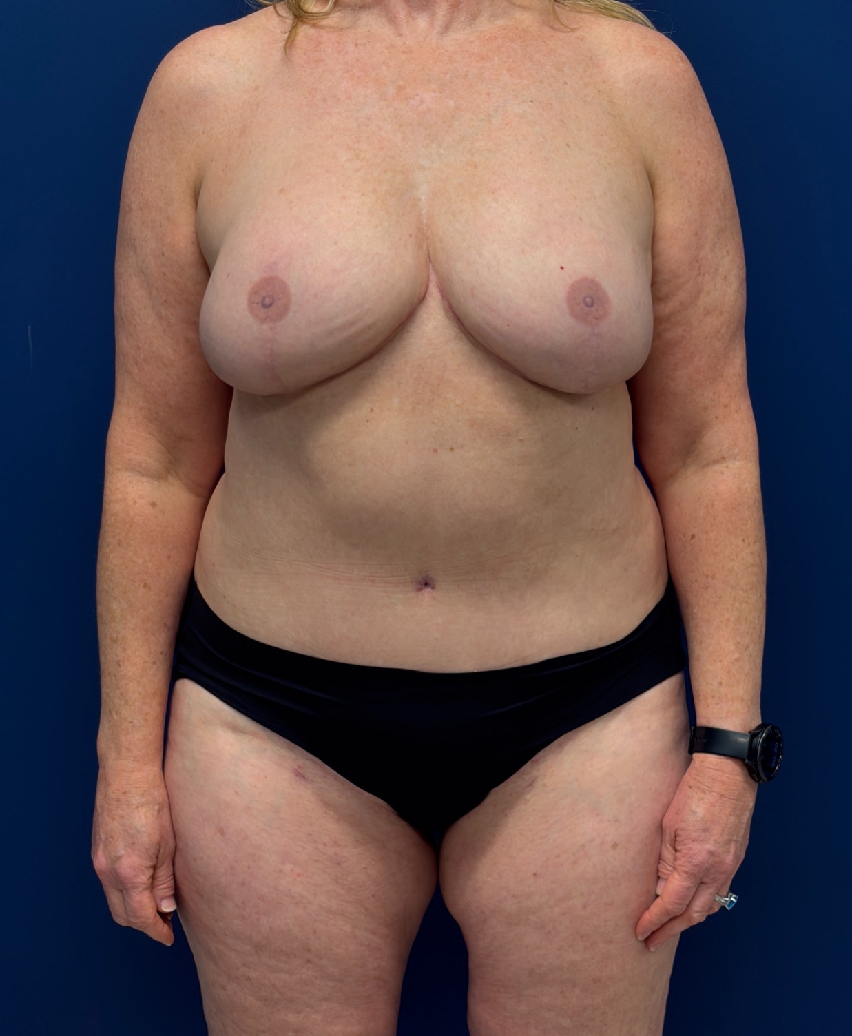 Bilateral-DIEP-Flap-Case--8499 | After Dr. Samir Rao 1