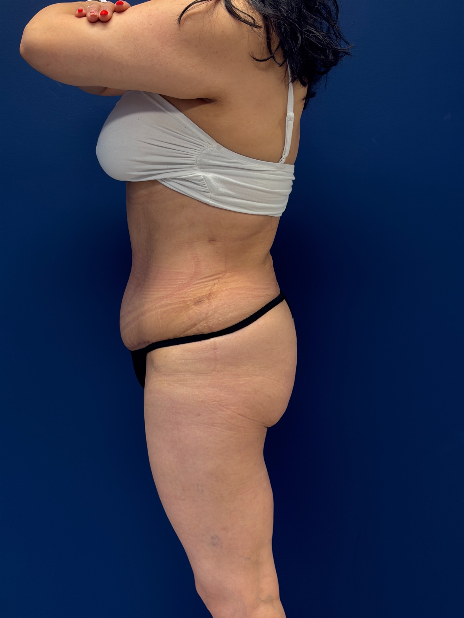 Abdominoplasty-Case--7989 | After Tummy Tuck 2