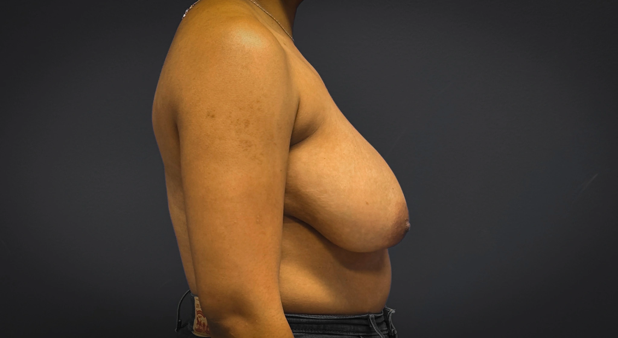 Breast-Reduction-Case--7089 | Before Breast Reduction 2