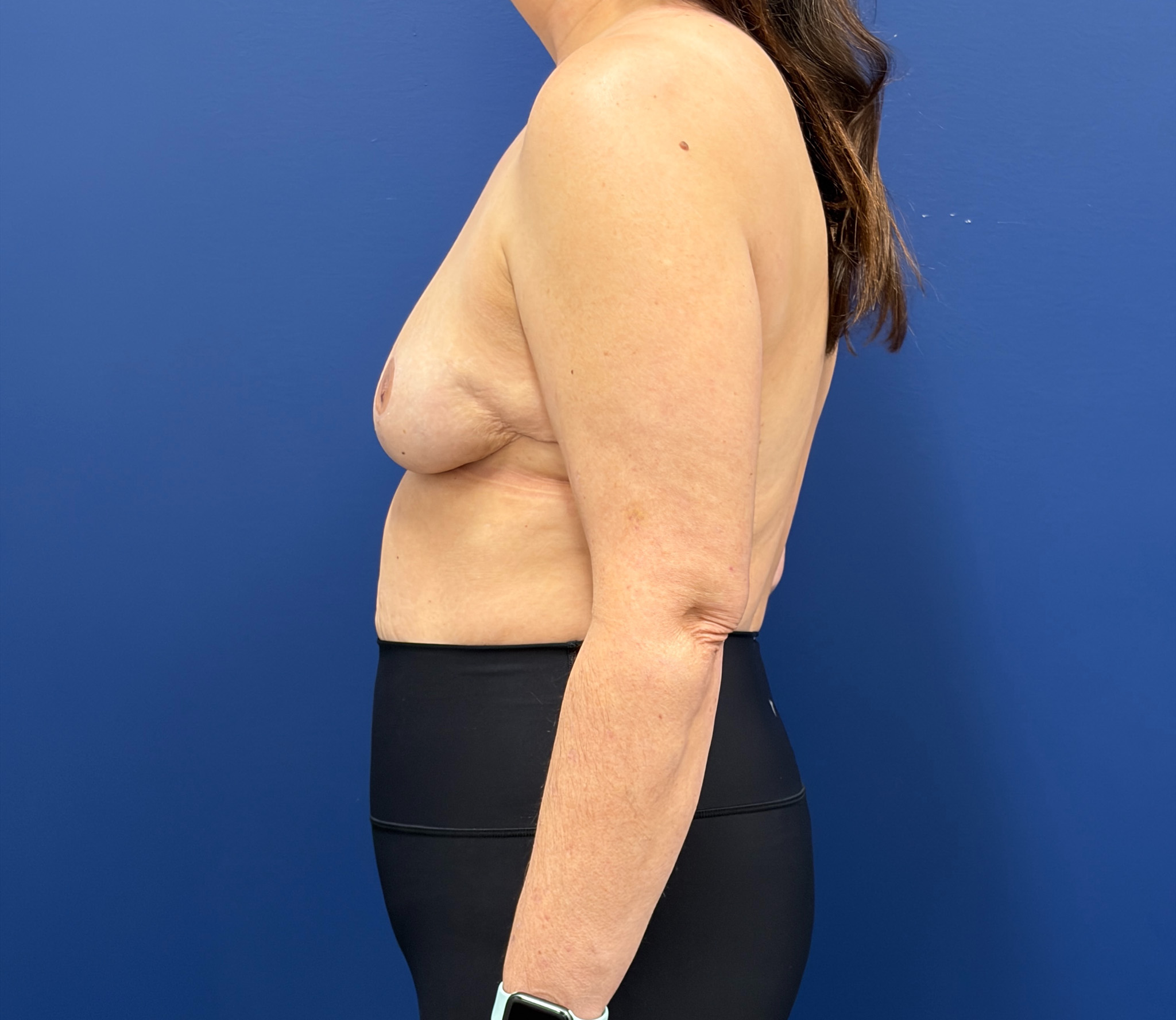 Breast-Reduction-Case--7709 | After Breast Reduction 2