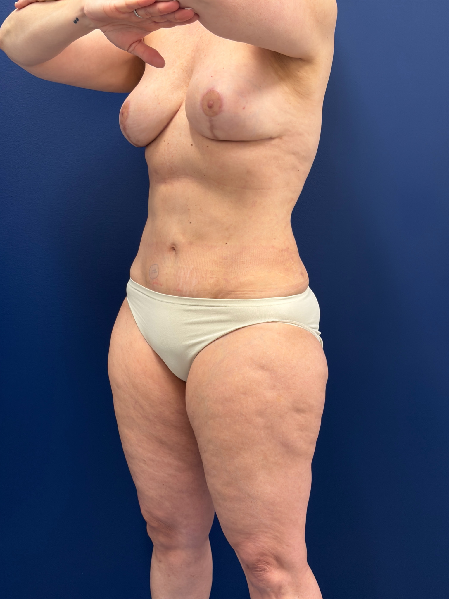 Mastopexy-with-Galaflex-Case--9485 | After Breast Lift 11