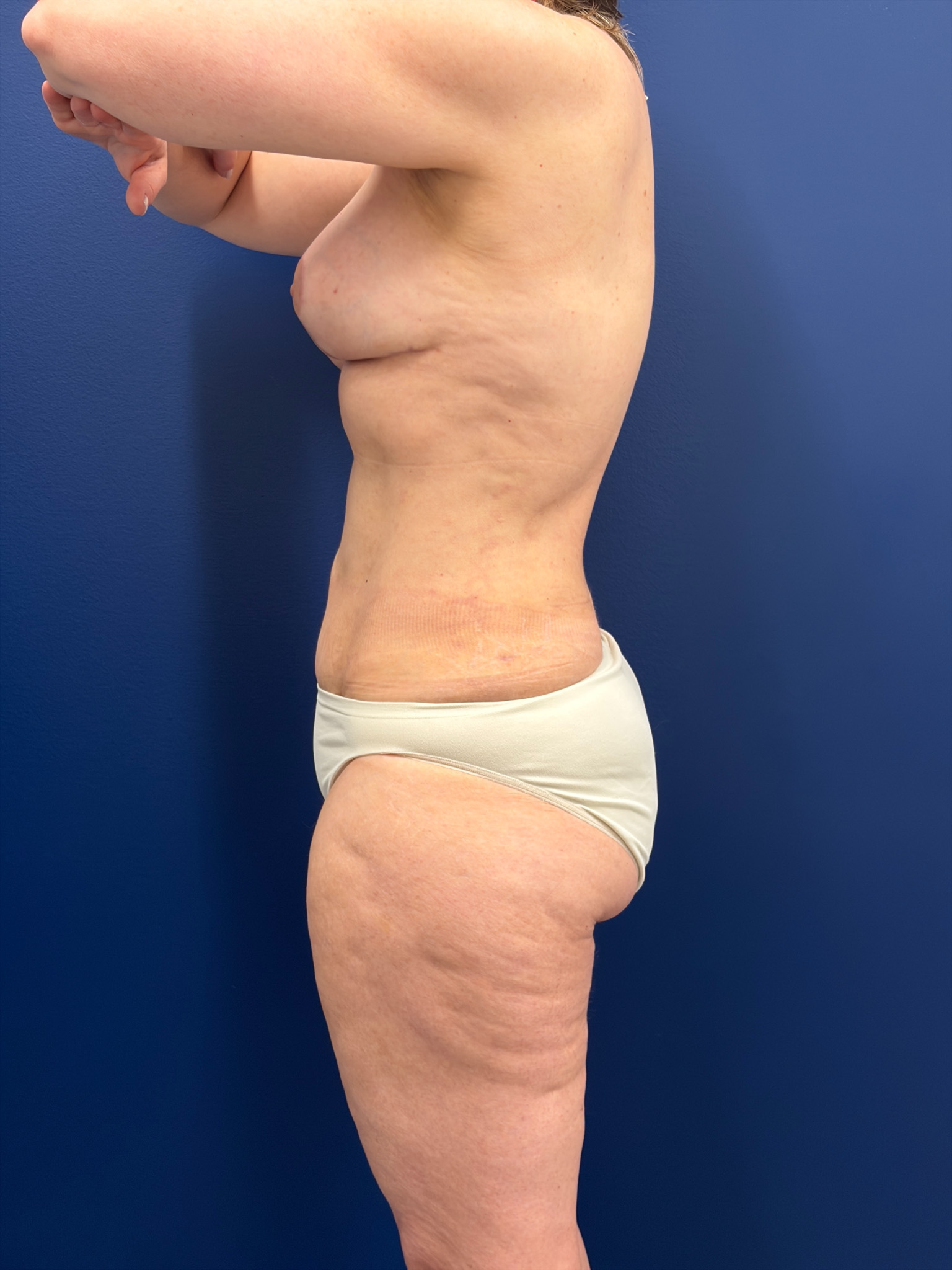 Mastopexy-with-Galaflex-Case--9485 | After Breast Lift 9