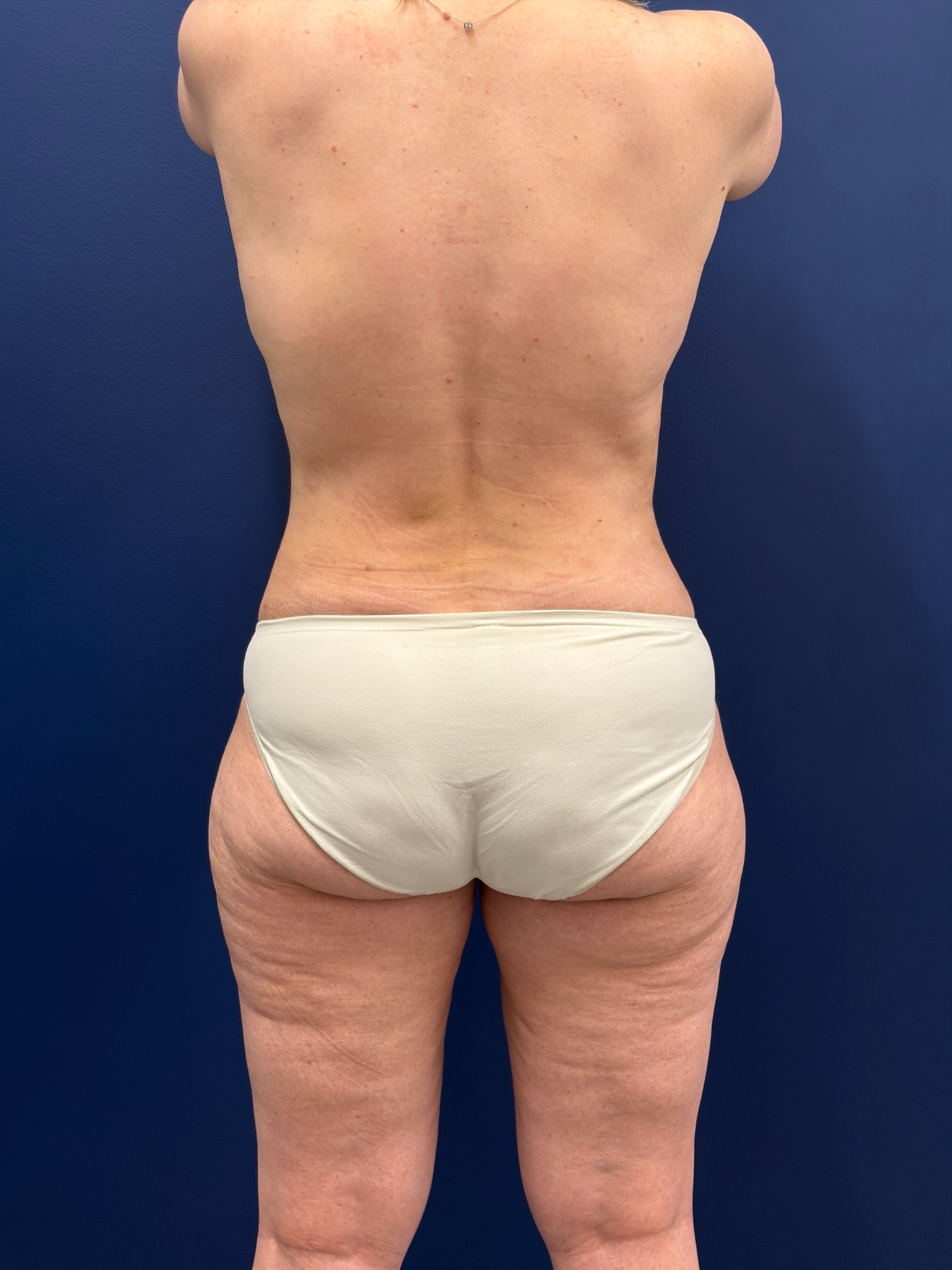 Mastopexy-with-Galaflex-Case--9485 | After Breast Lift 6