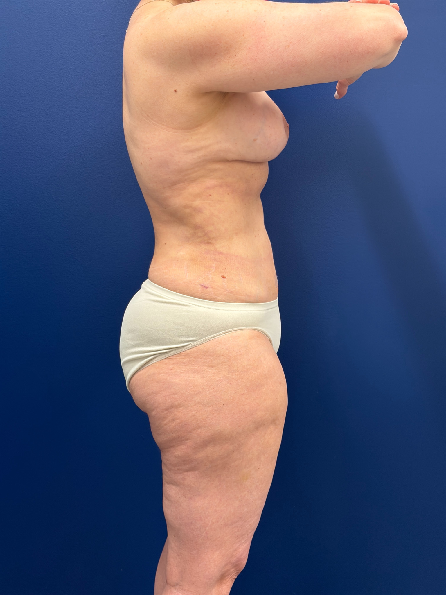 Mastopexy-with-Galaflex-Case--9485 | After Breast Lift 8