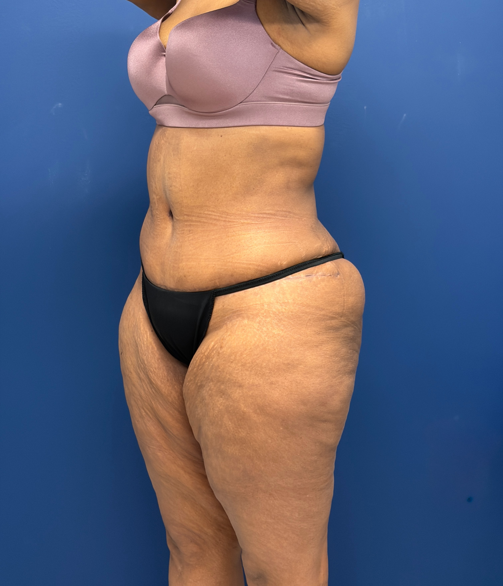Lipoabdominoplasty-Case--6846 | After Liposuction 4