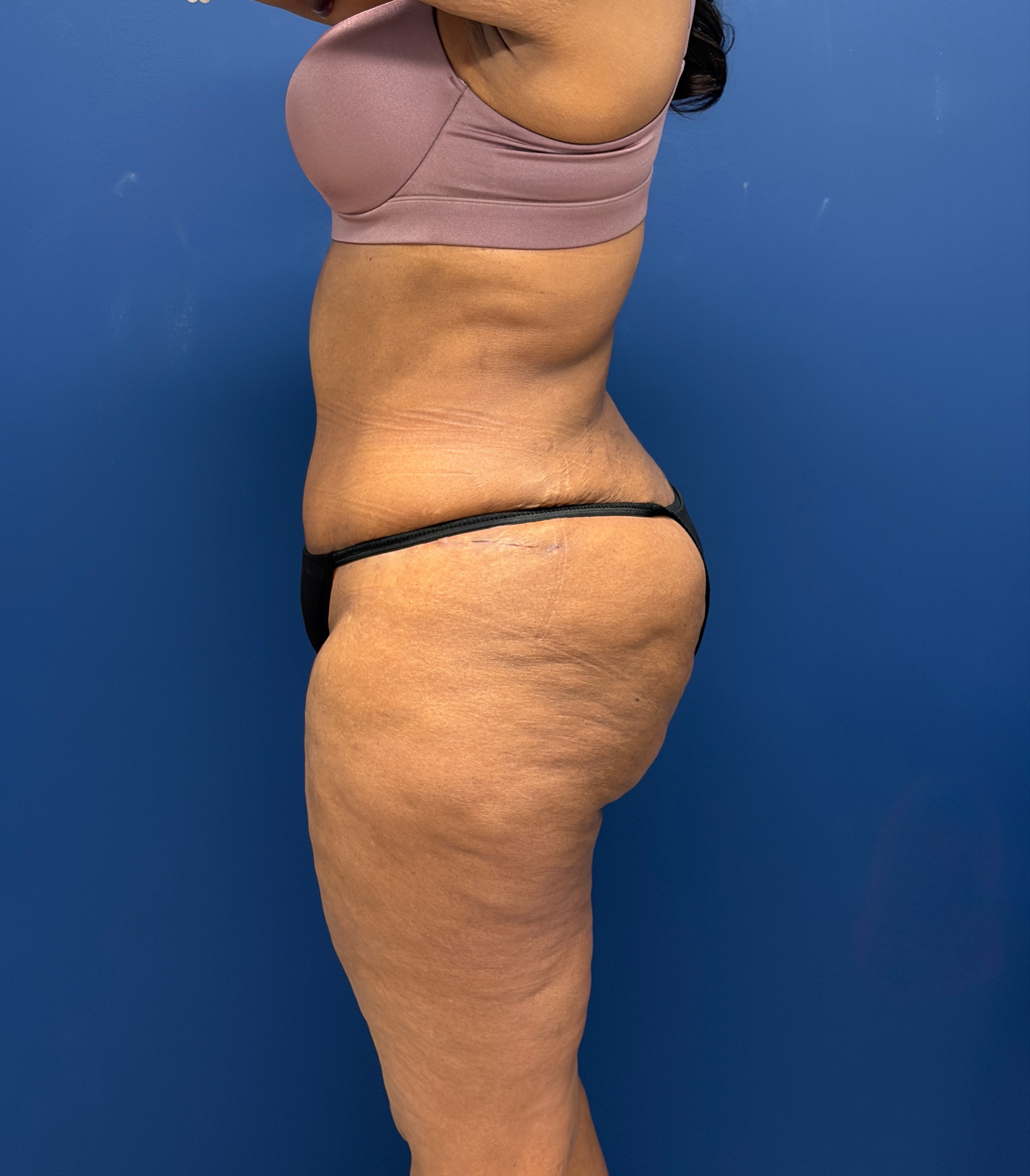 Lipoabdominoplasty-Case--6846 | After Liposuction 2