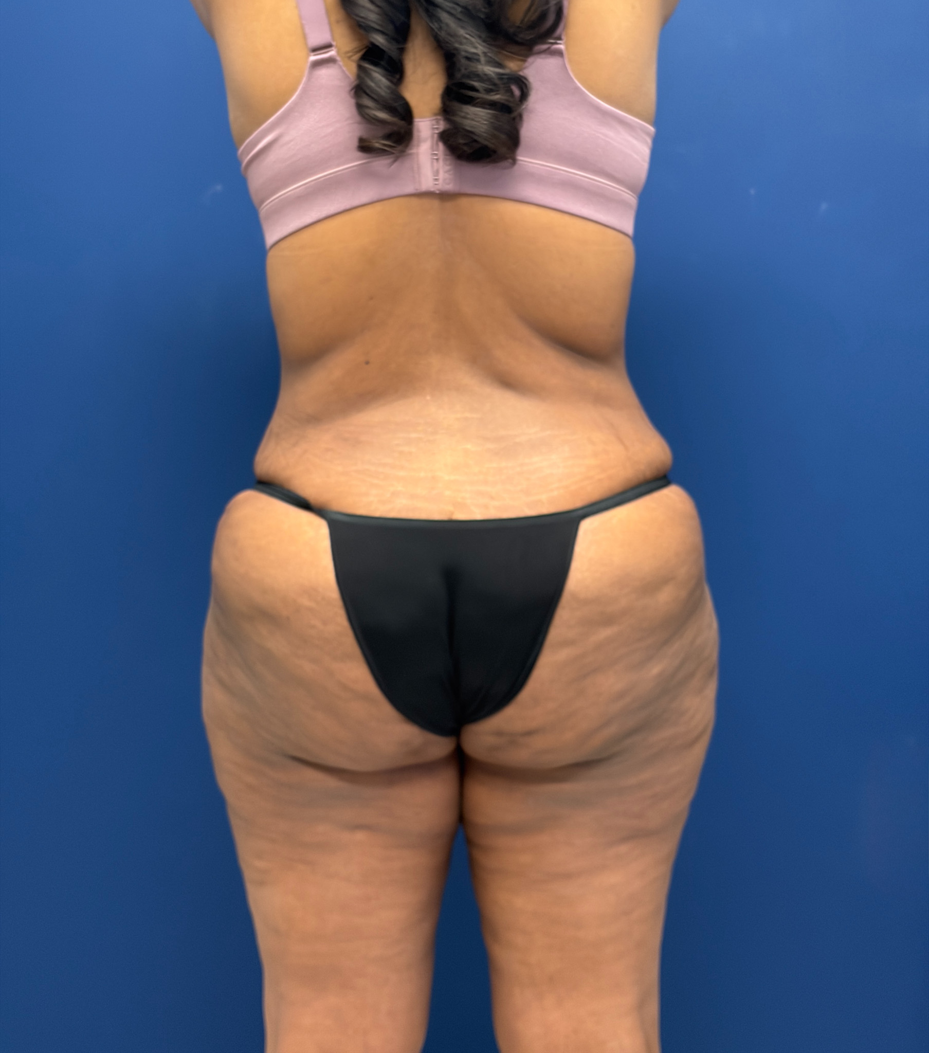 Lipoabdominoplasty-Case--6846 | After Liposuction 6
