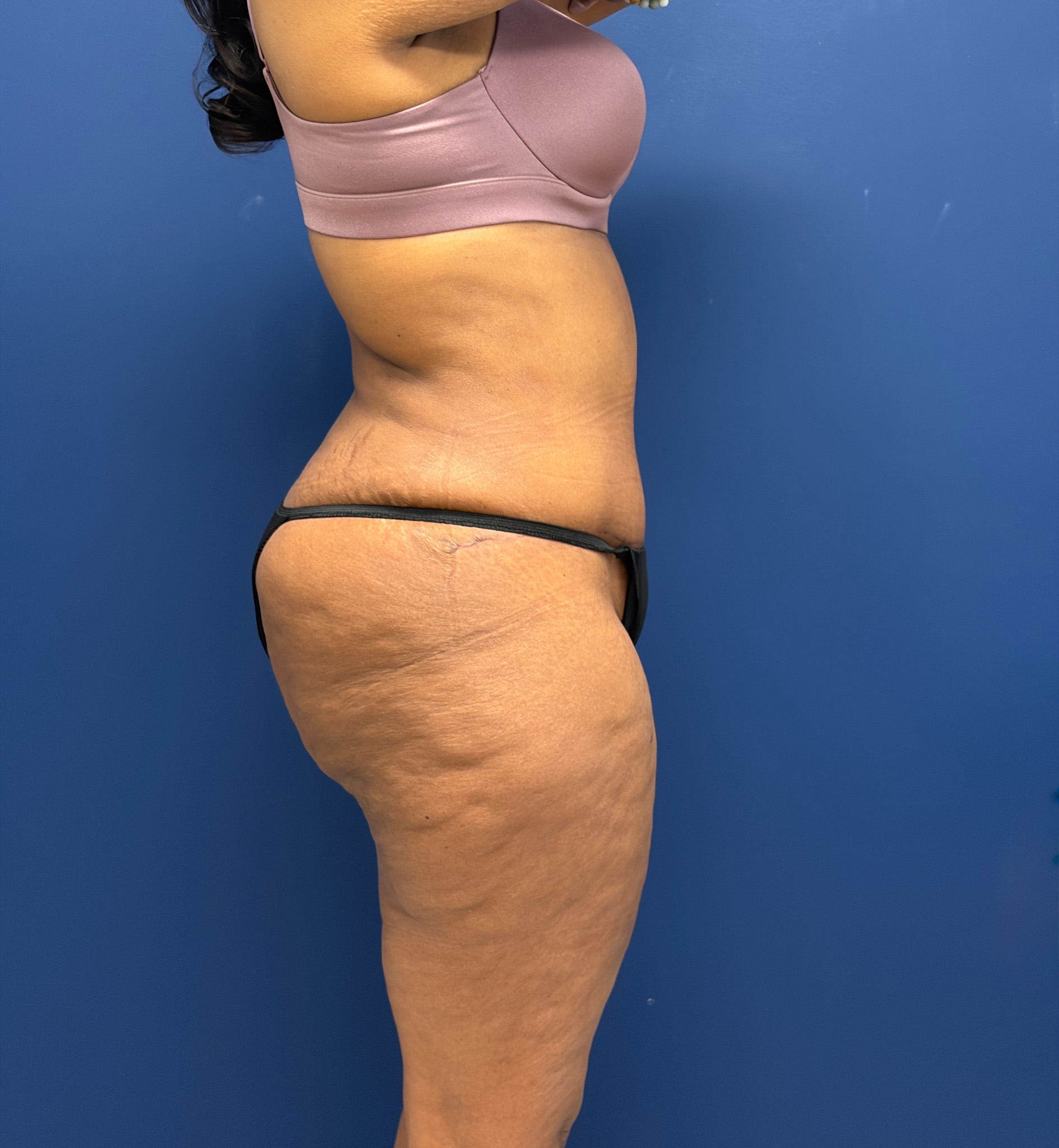 Lipoabdominoplasty-Case--6846 | After Liposuction 3