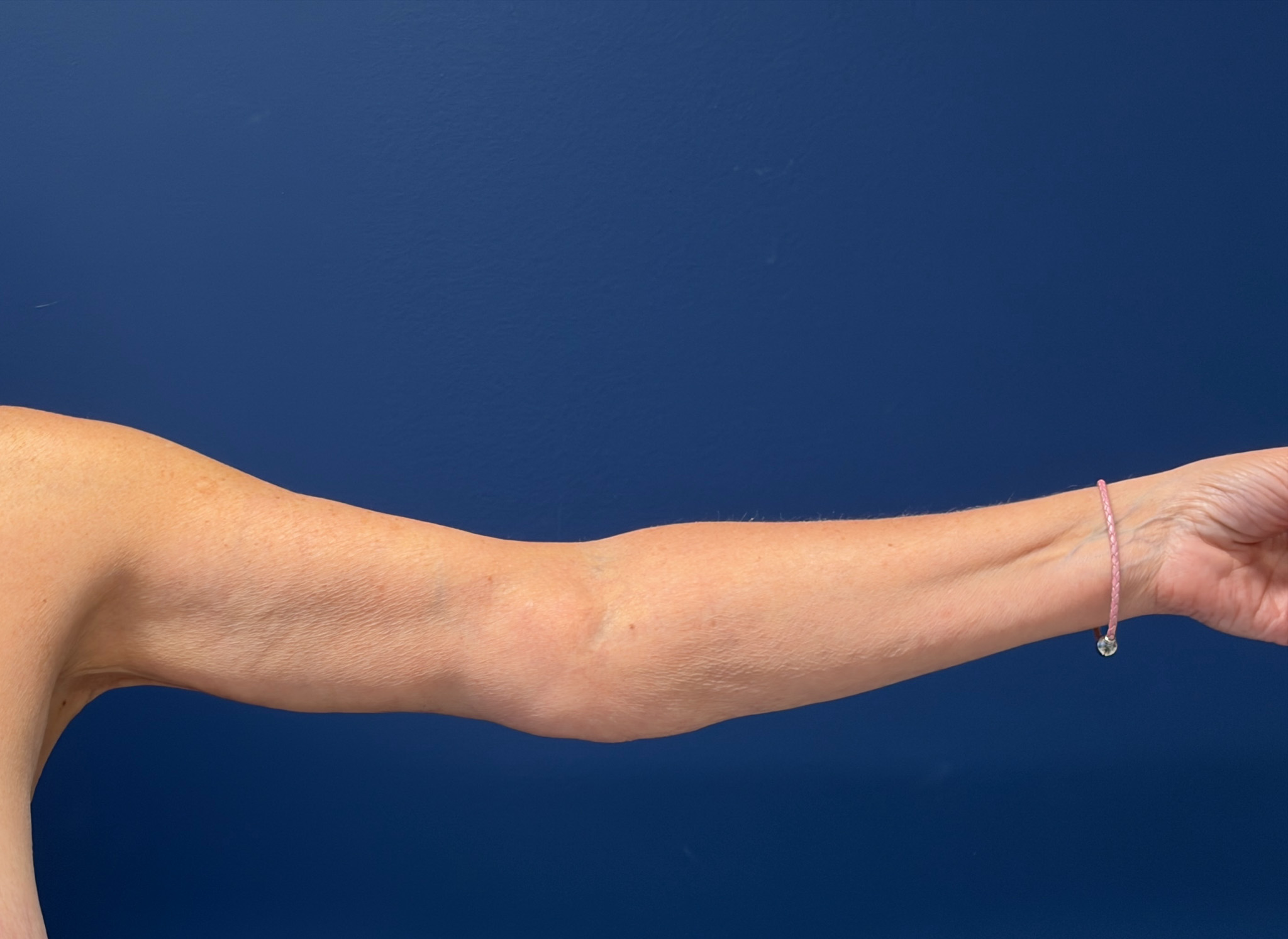 Brachioplasty-Case--4934 | After Arm Lift 2