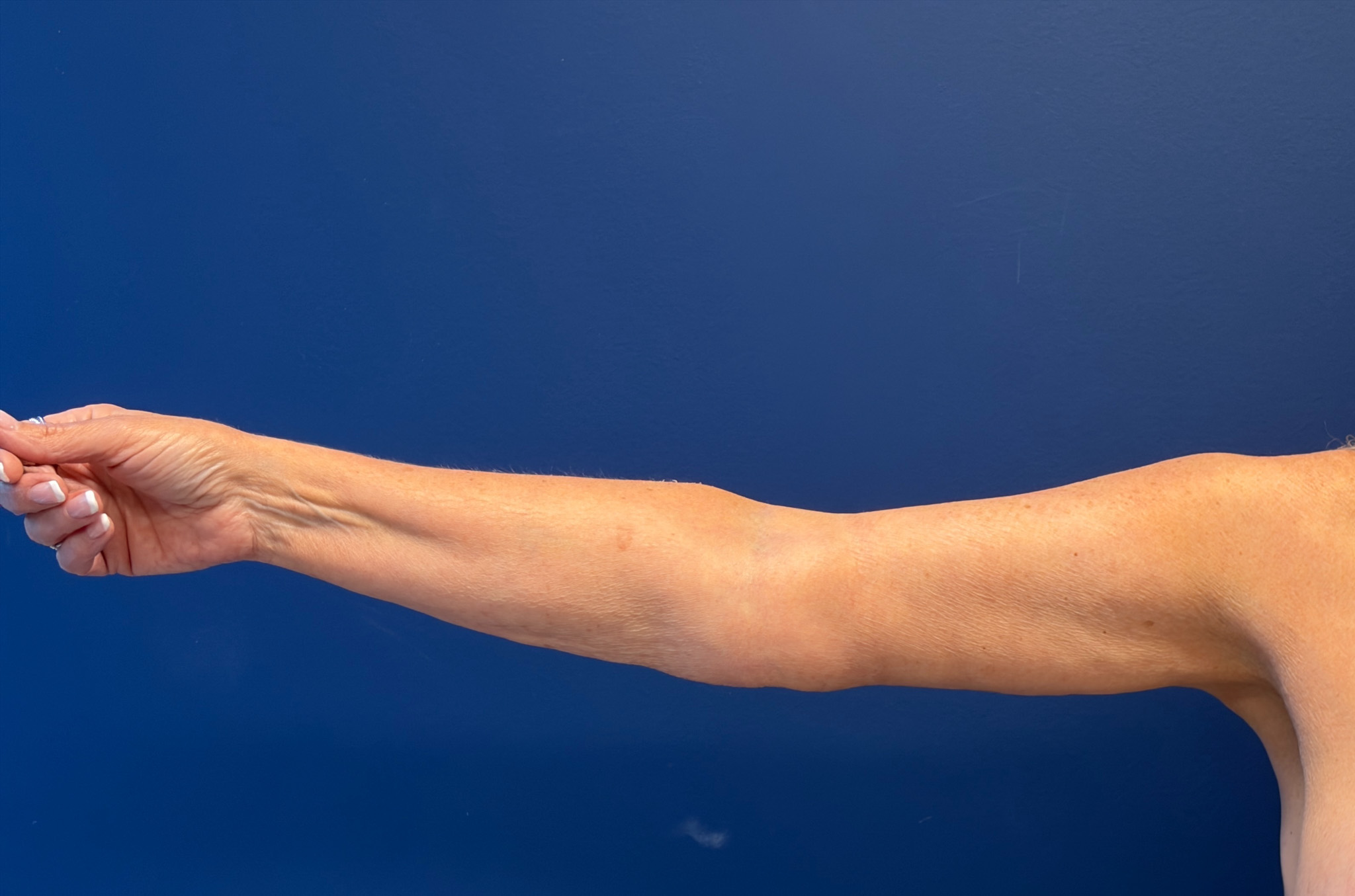 Brachioplasty-Case--4934 | After Arm Lift 1