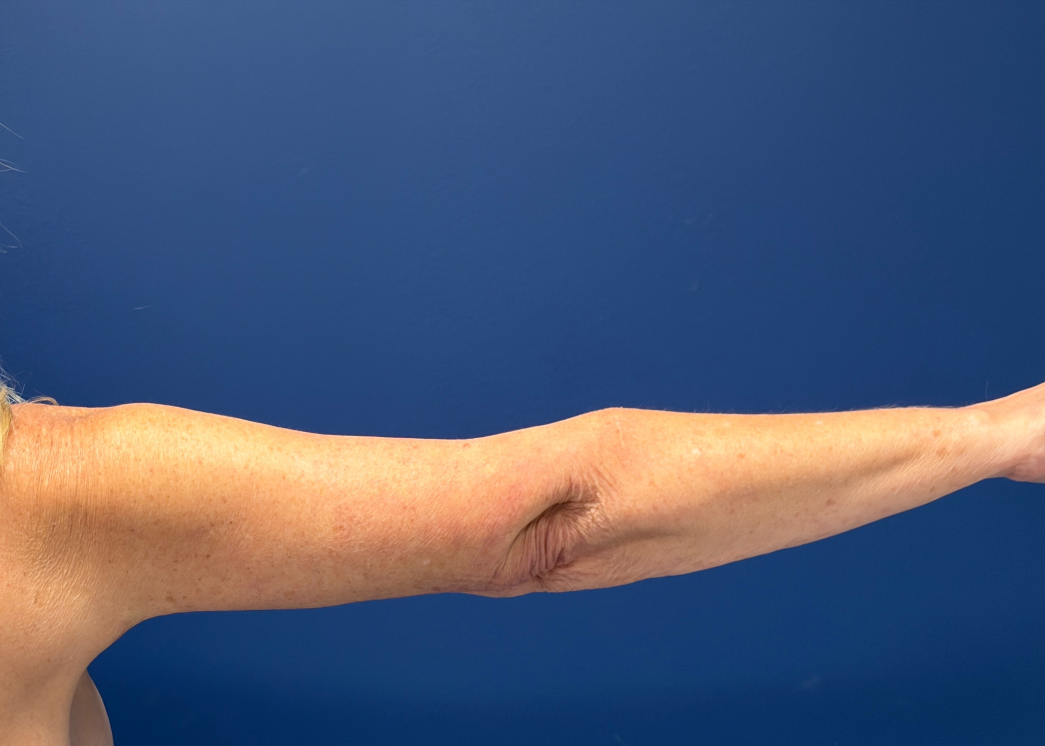 Brachioplasty-Case--4934 | After Arm Lift 4