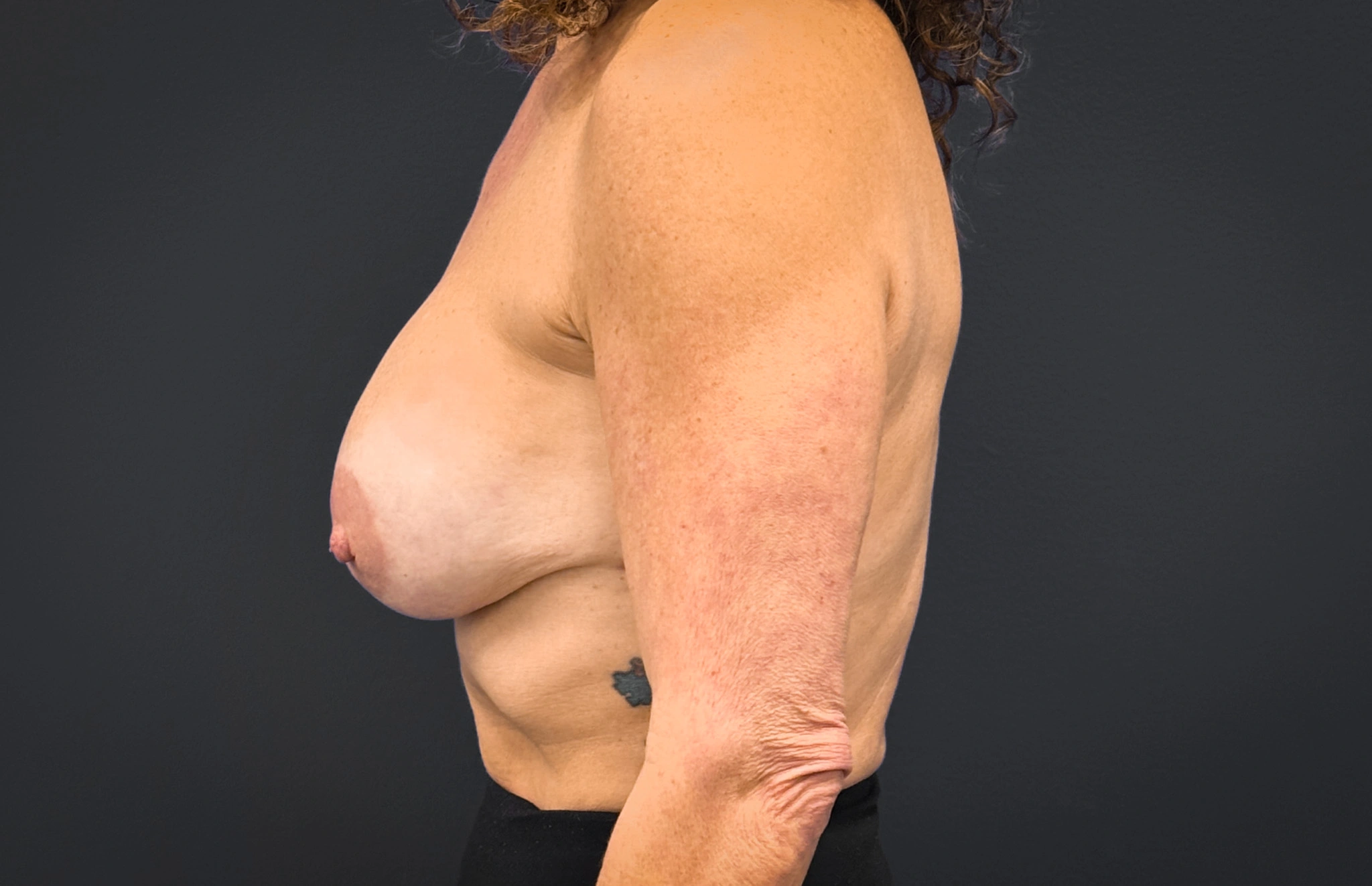 Left profile of patient after undergoing breast reconstruction surgery