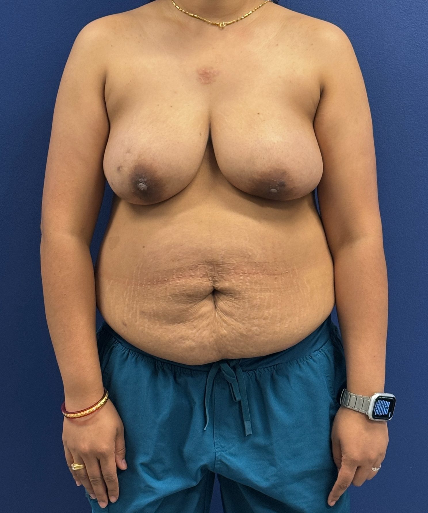 Nipple-Reconstruction-Case--1343 | Before Dr. Samir Rao 1
