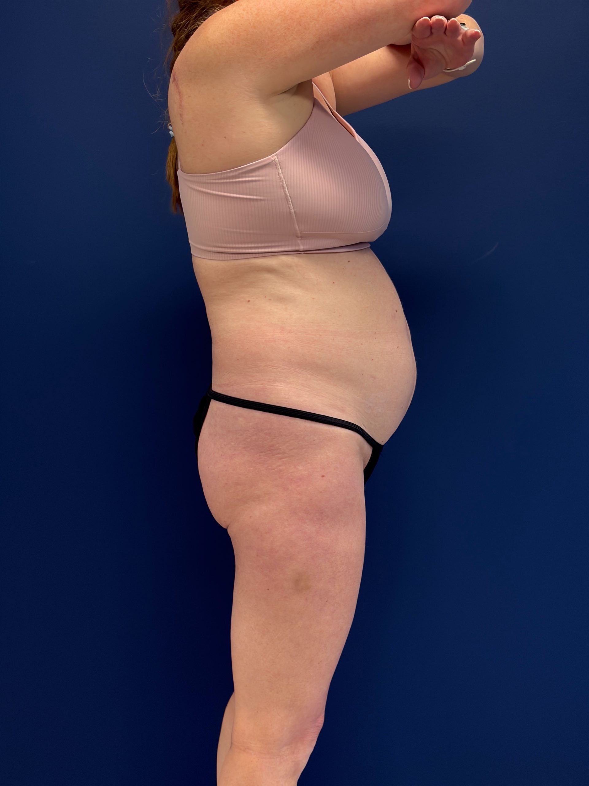 Abdominoplasty-Case--1715 | Before Tummy Tuck 3