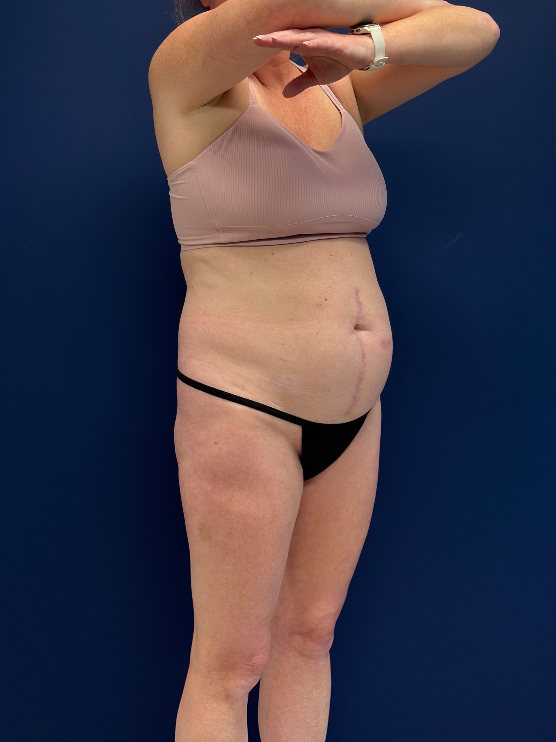 Abdominoplasty-Case--1715 | Before Tummy Tuck 5