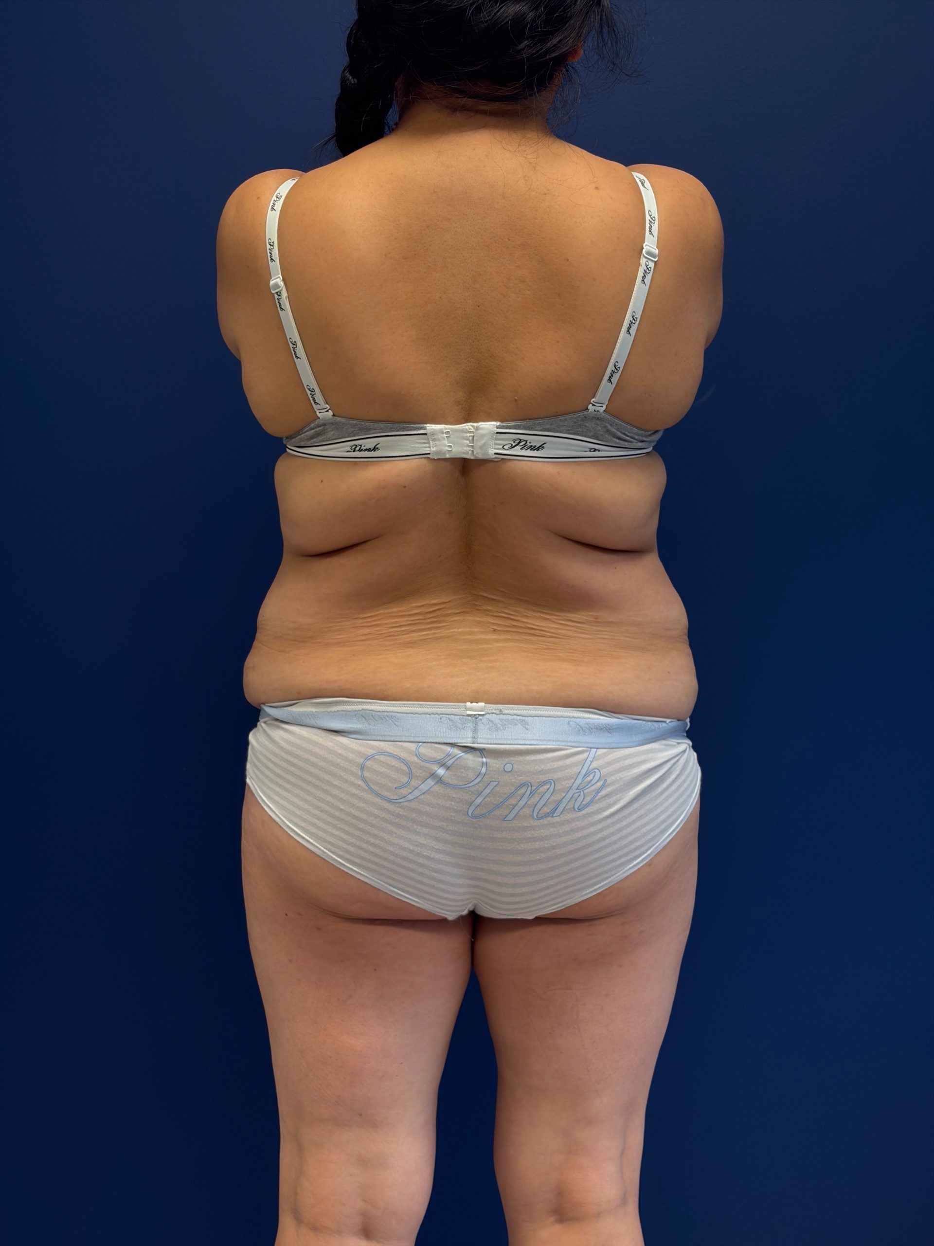 Abdominoplasty-Case--7989 | Before Tummy Tuck 6