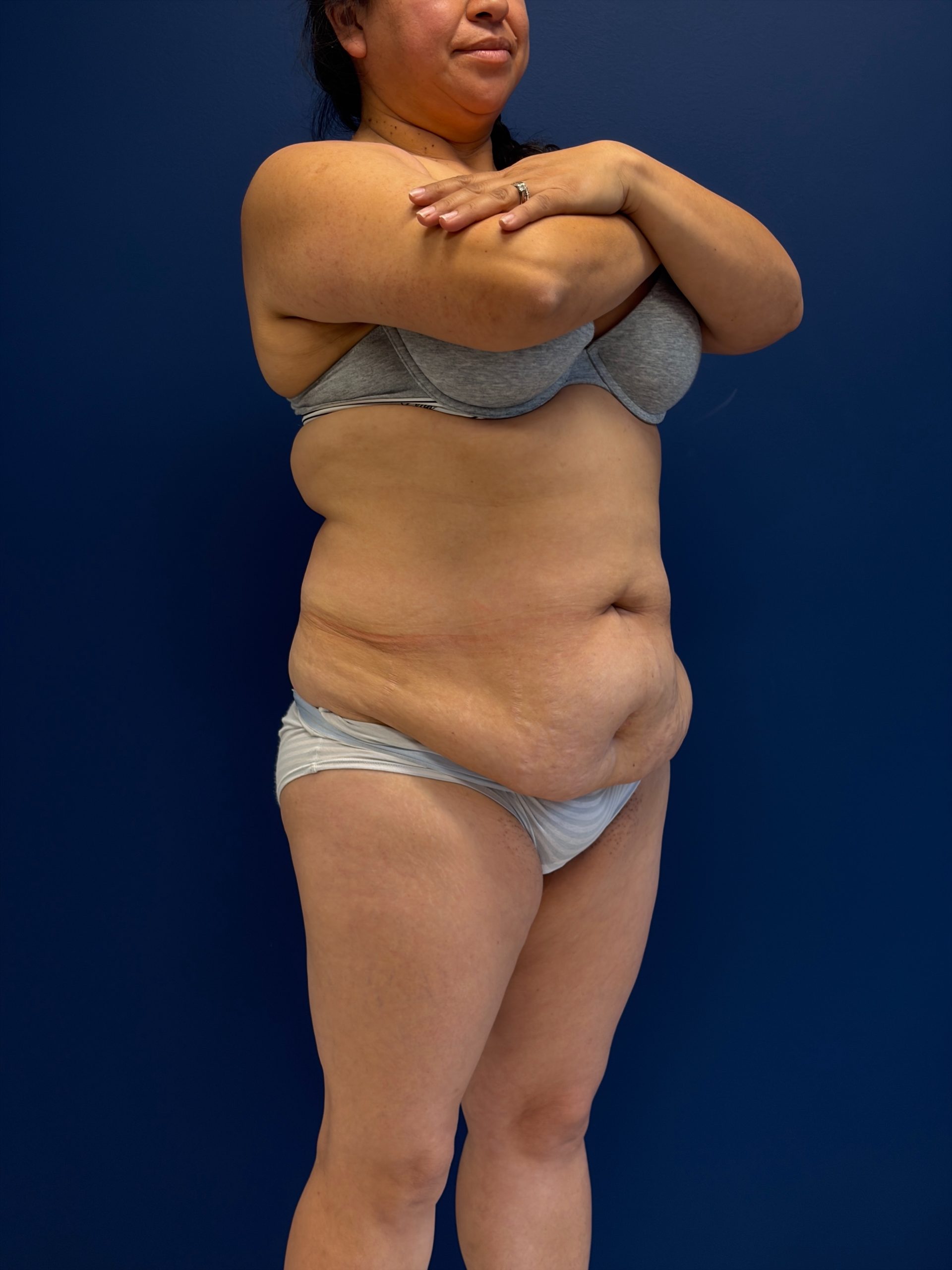 Abdominoplasty-Case--7989 | Before Tummy Tuck 5