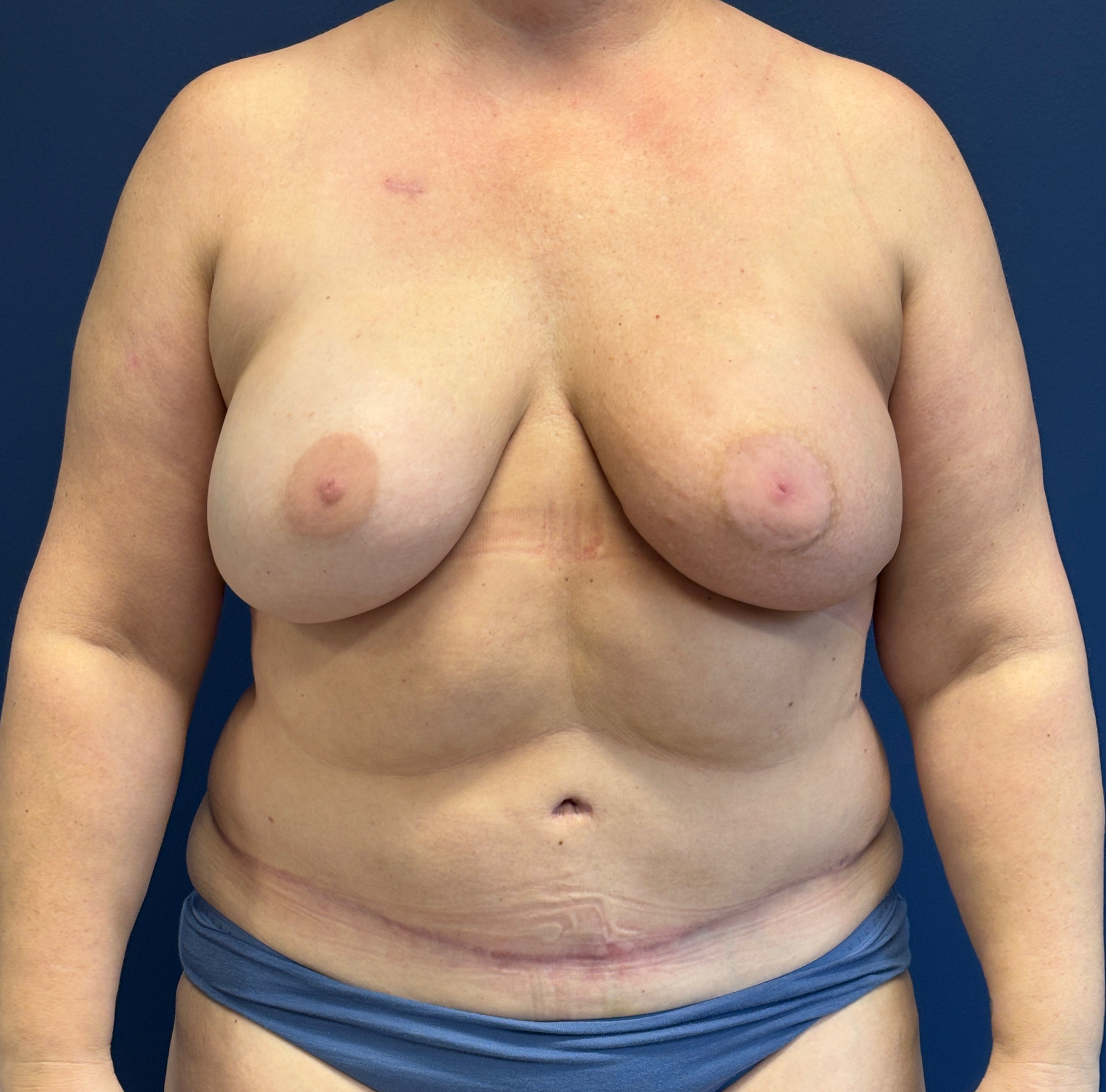 DIEP-Flap-Case--1682 | After DIEP Flap 1