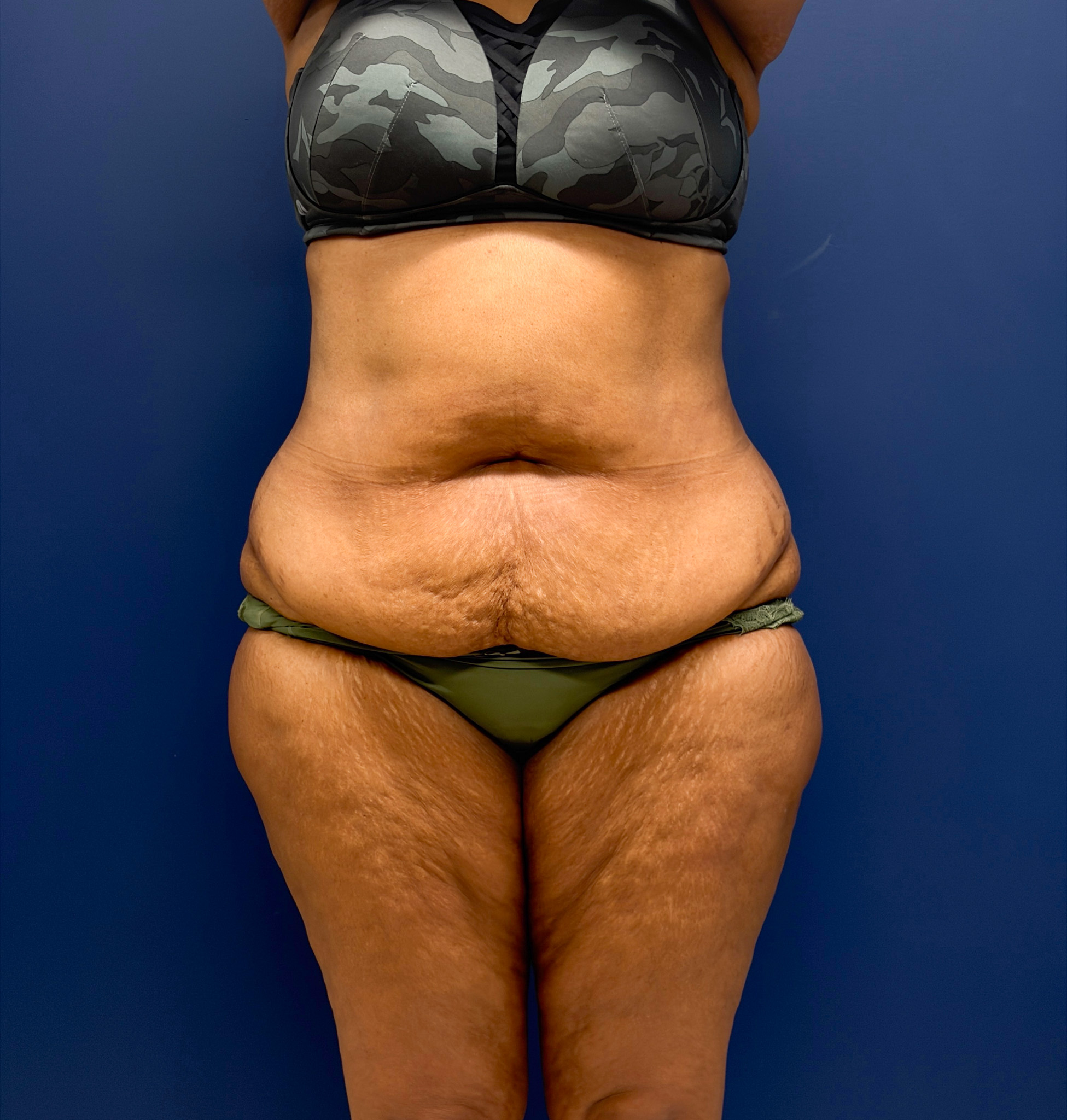 Lipoabdominoplasty-Case--6846 | Before Liposuction 1
