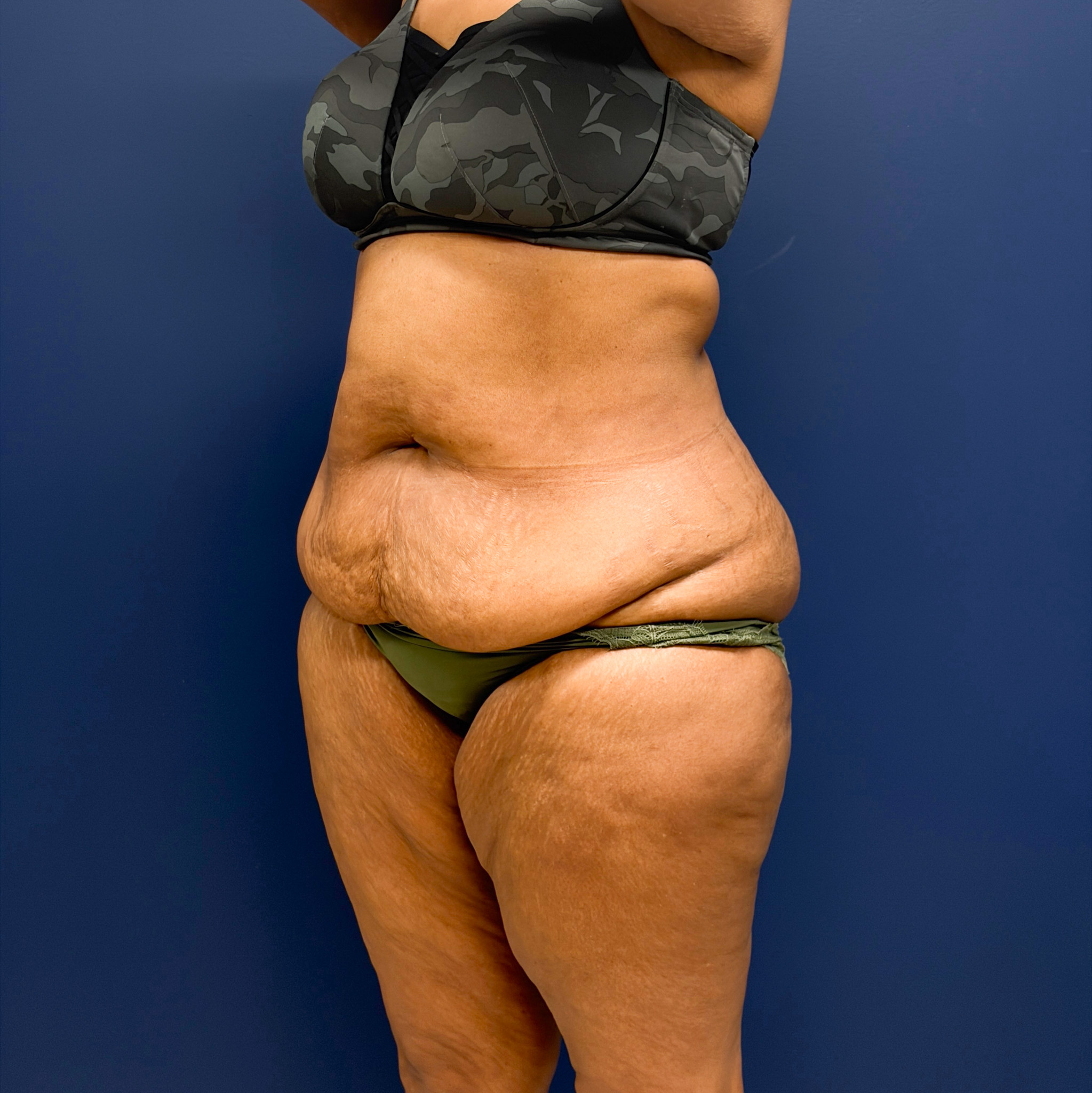 Lipoabdominoplasty-Case--6846 | Before Liposuction 4