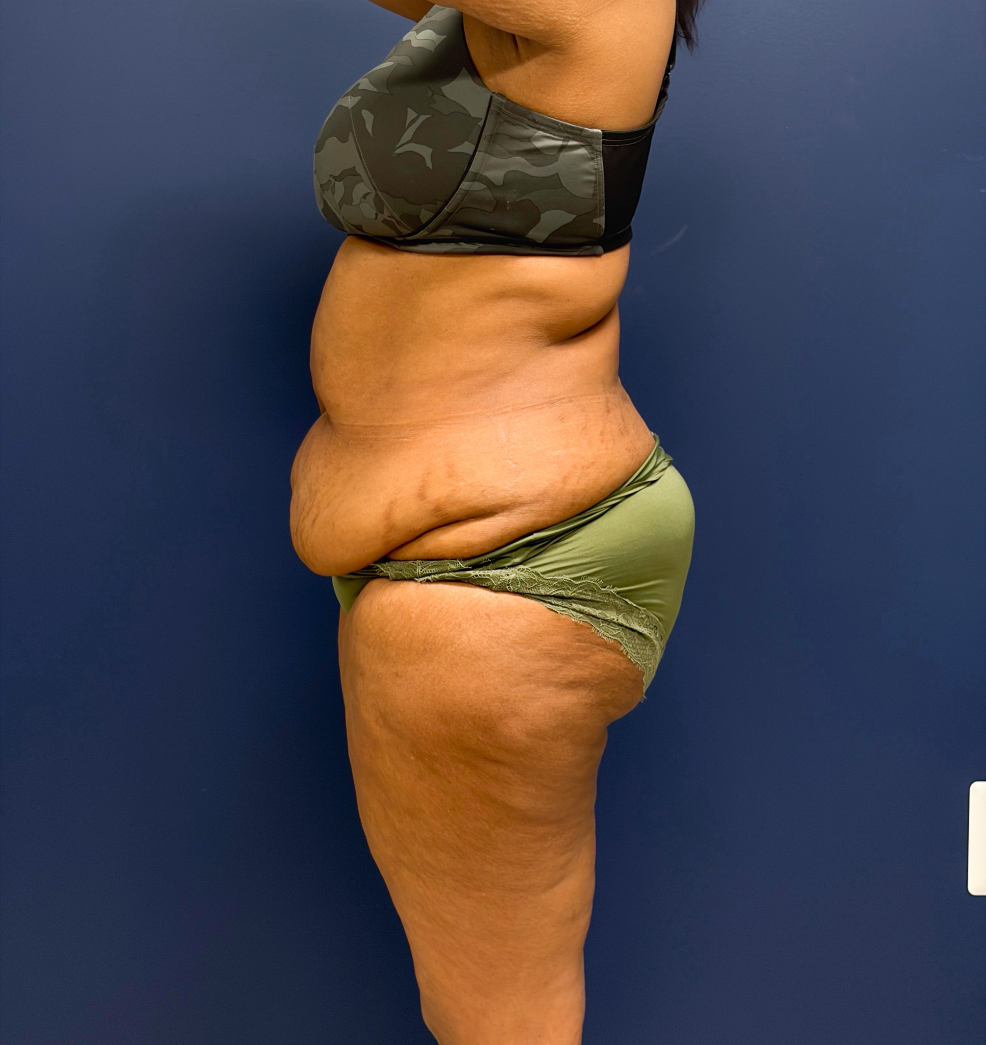 Lipoabdominoplasty-Case--6846 | Before Liposuction 2