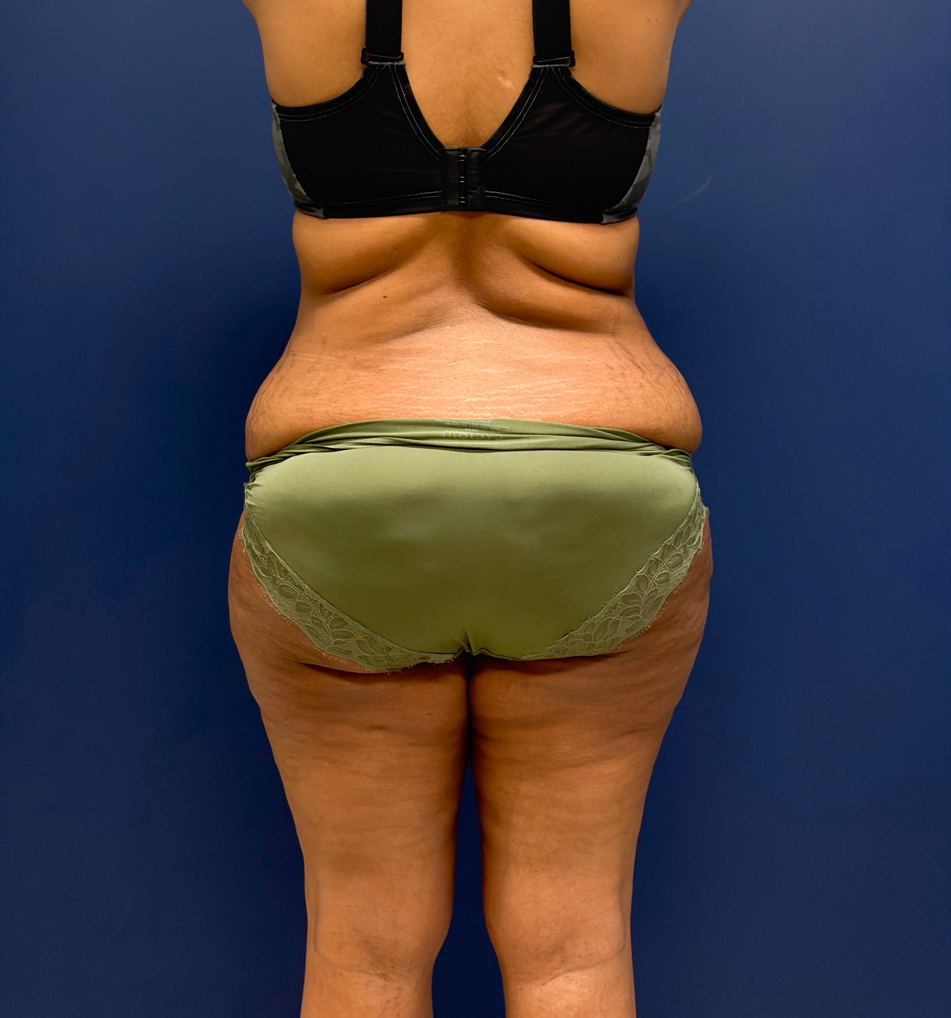 Lipoabdominoplasty-Case--6846 | Before Liposuction 6