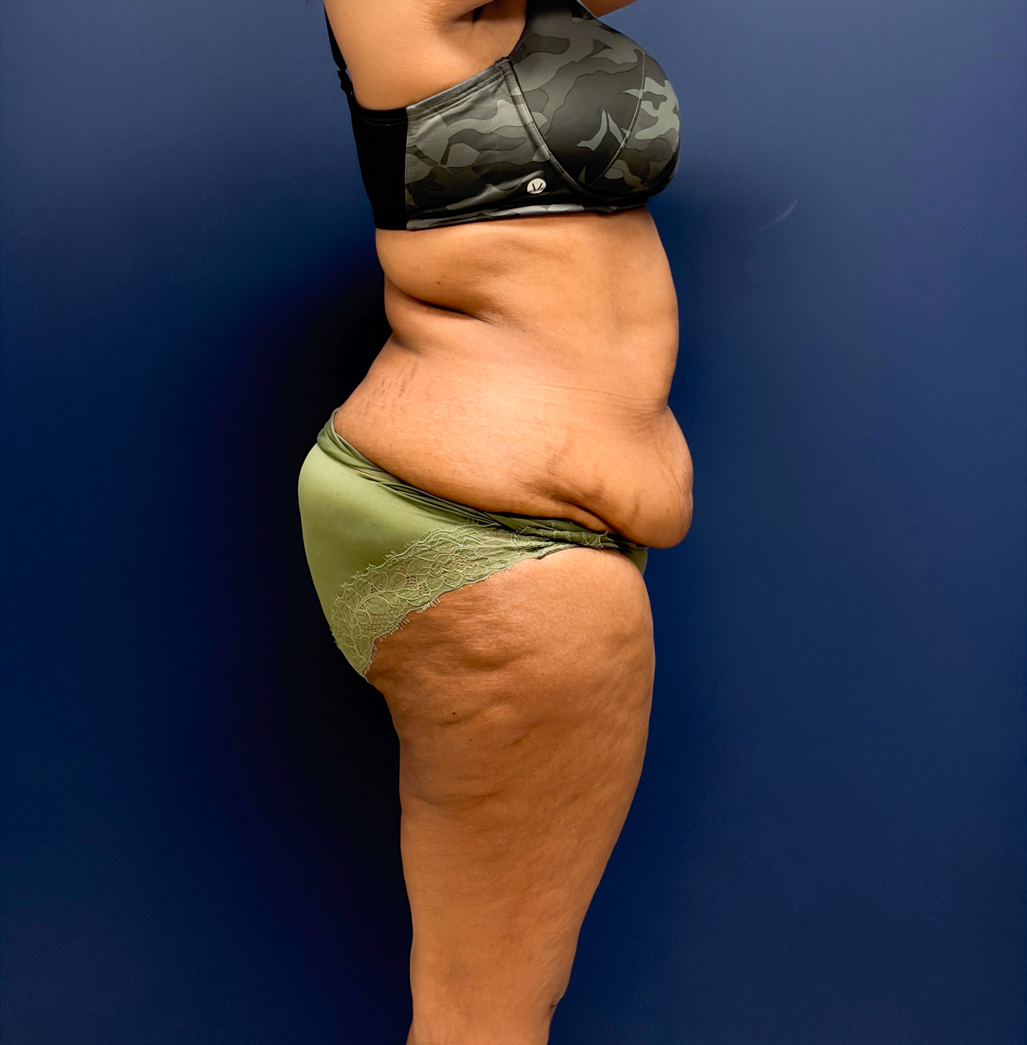 Lipoabdominoplasty-Case--6846 | Before Liposuction 3