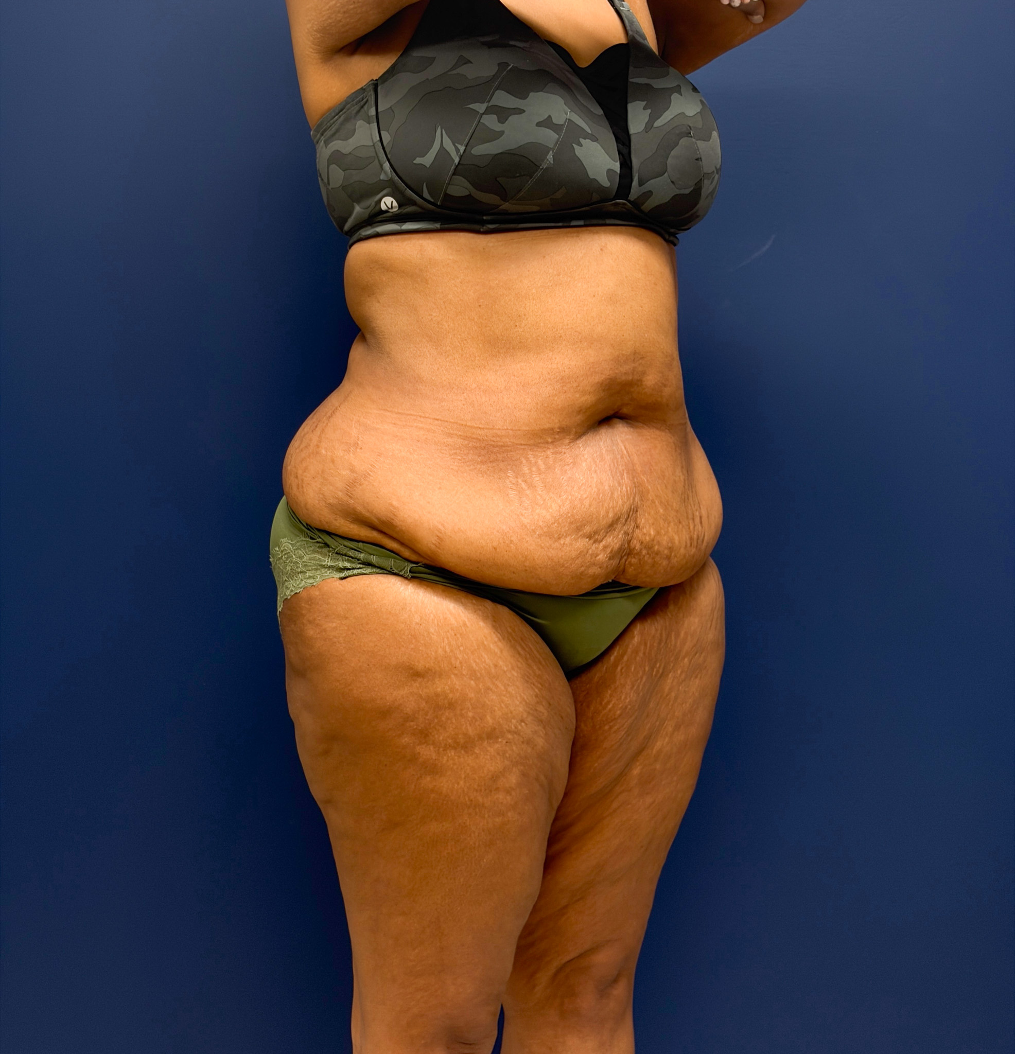 Lipoabdominoplasty-Case--6846 | Before Liposuction 5