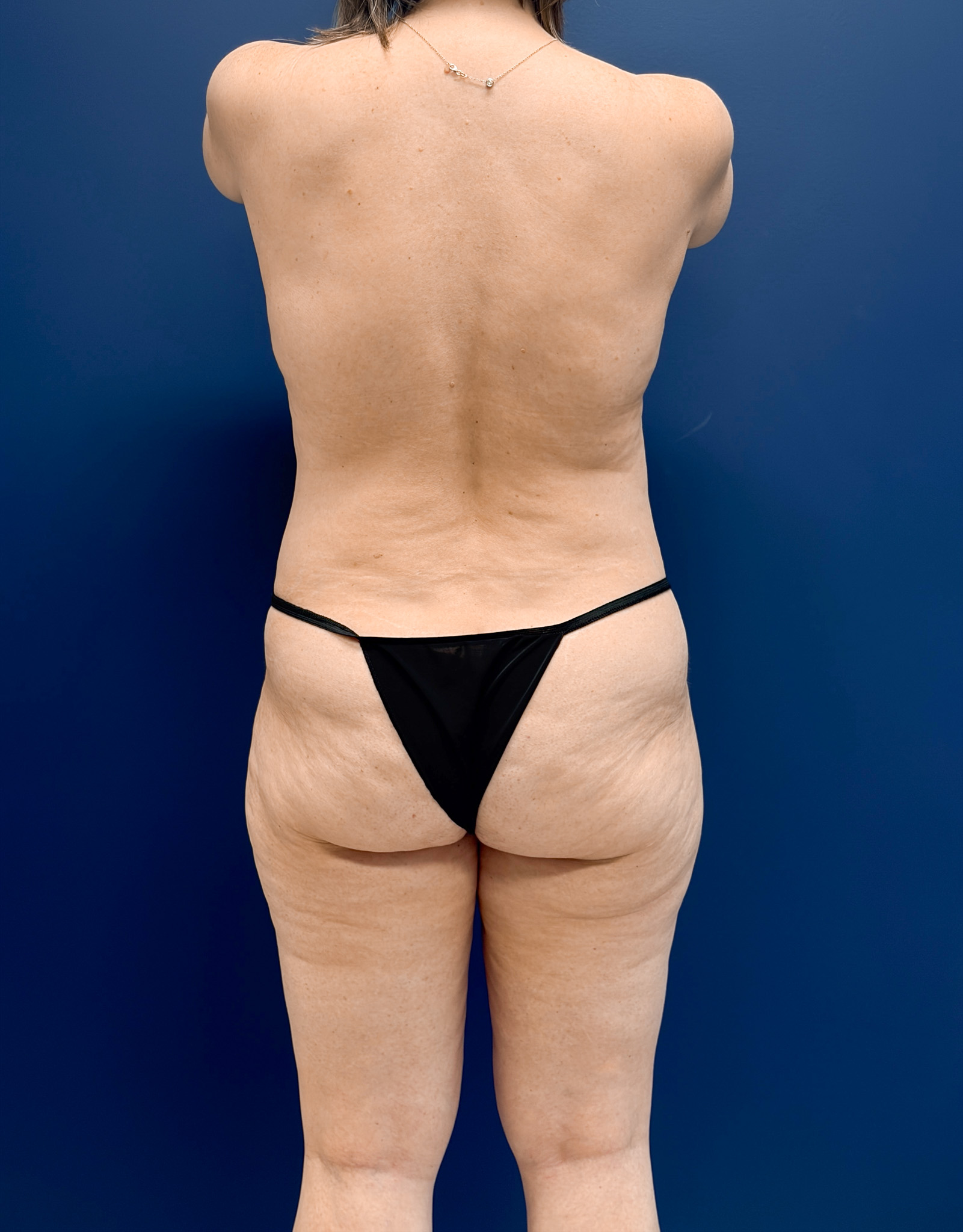 Mastopexy-with-Galaflex-Case--9485 | Before Breast Lift 6