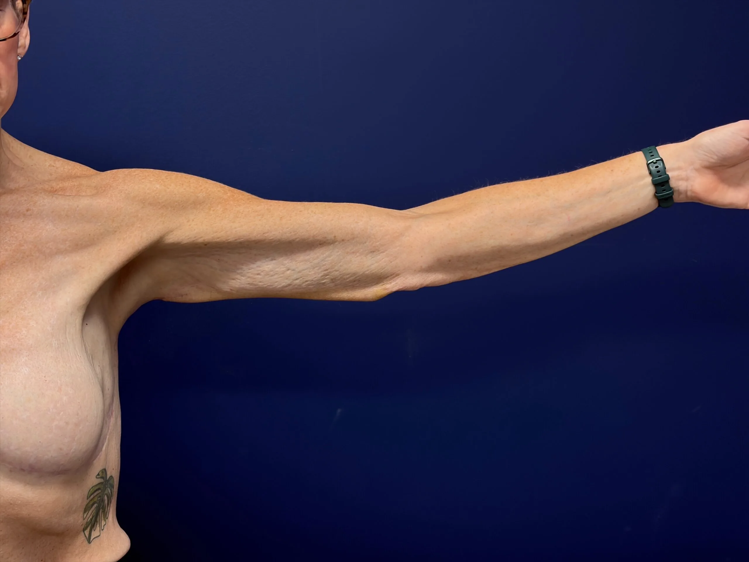 Brachioplasty-Case--3898 | After Arm Lift 2