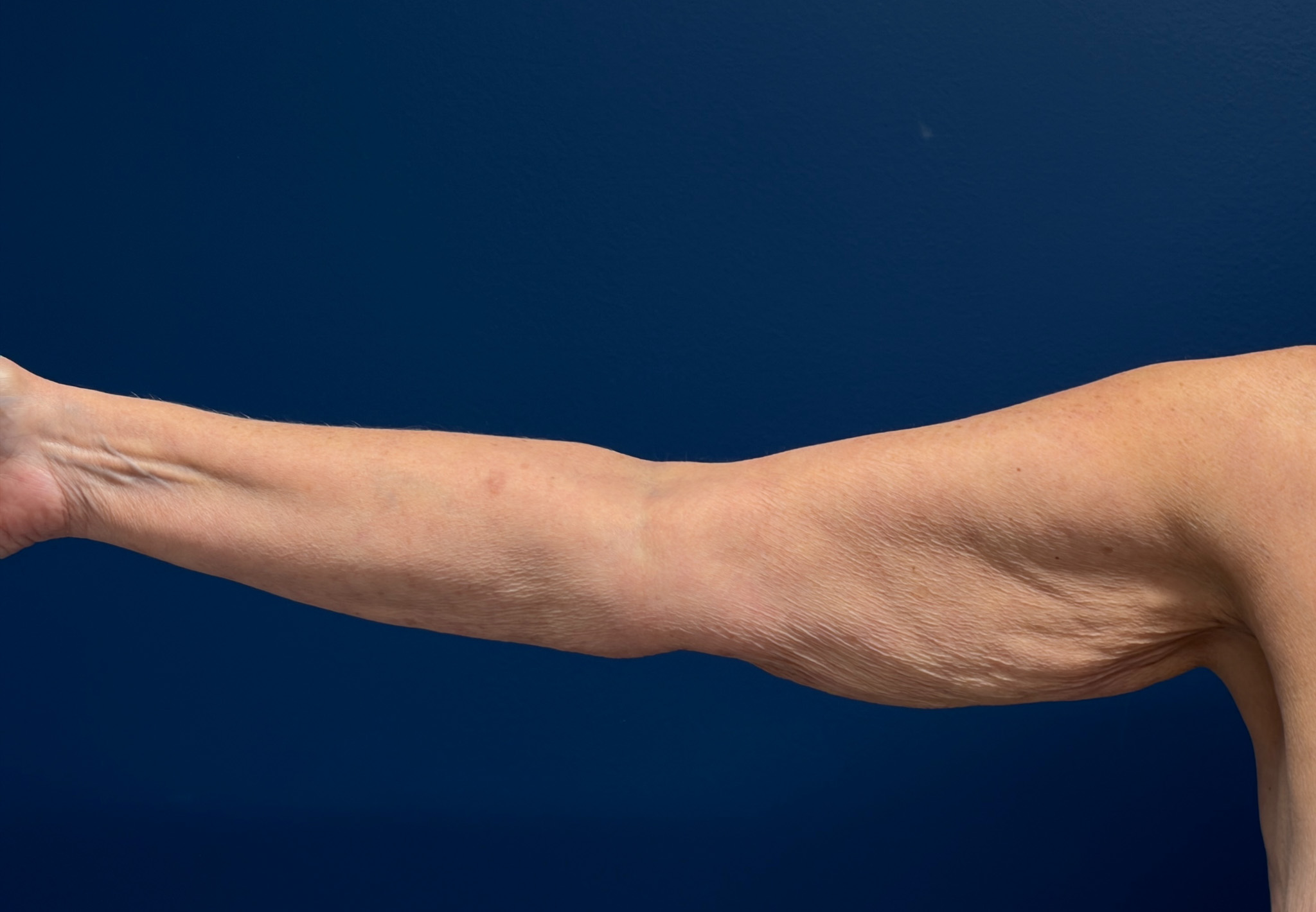 Brachioplasty-Case--4934 | Before Arm Lift 1