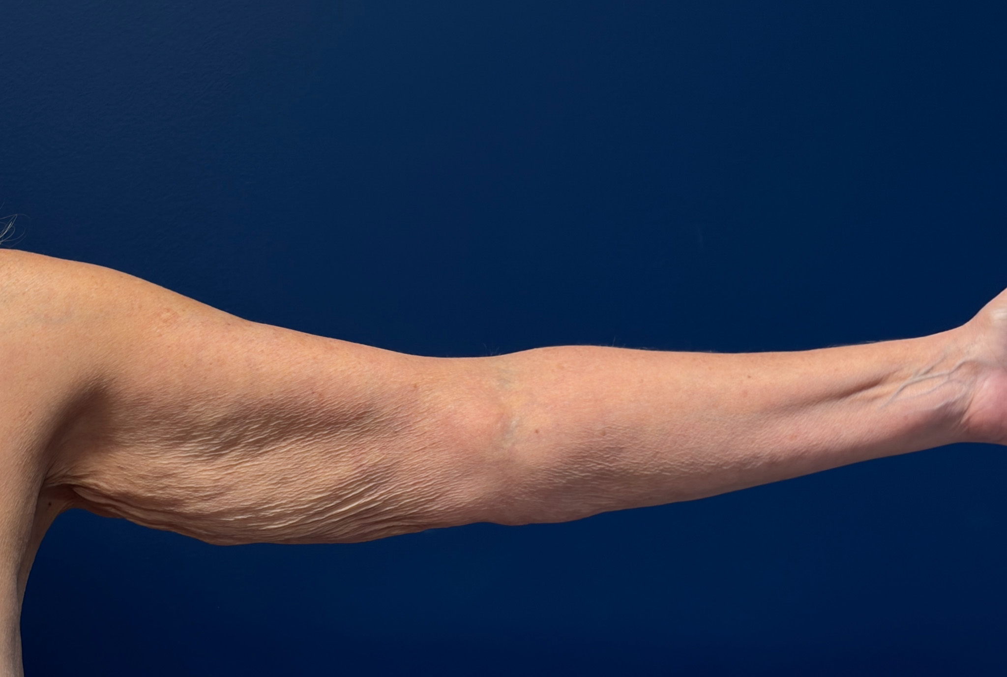 Brachioplasty-Case--4934 | Before Arm Lift 2