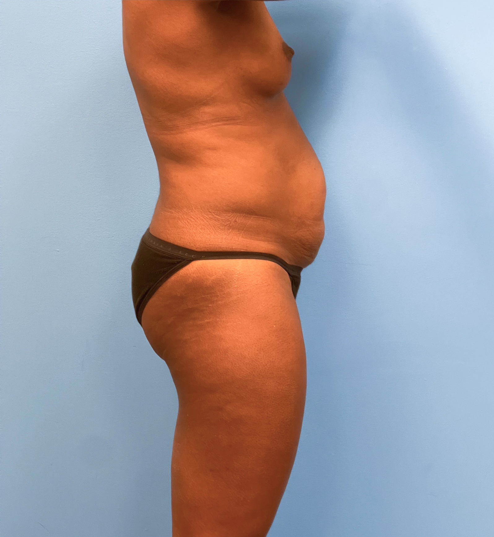 Abdominoplasty-Case--28134 | Before Tummy Tuck 2