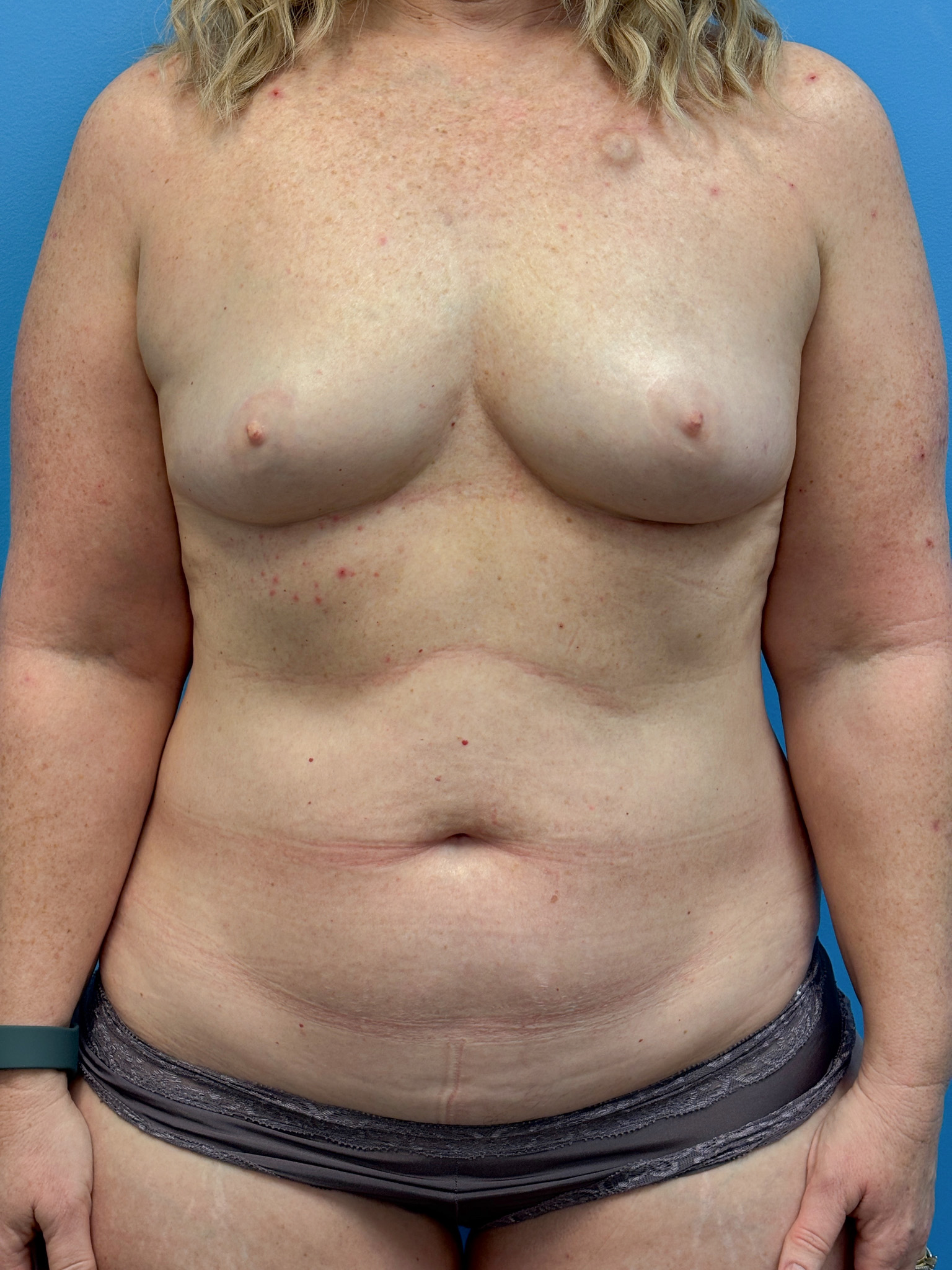 DIEP-Flap-Case--3138 | Before DIEP Flap 1