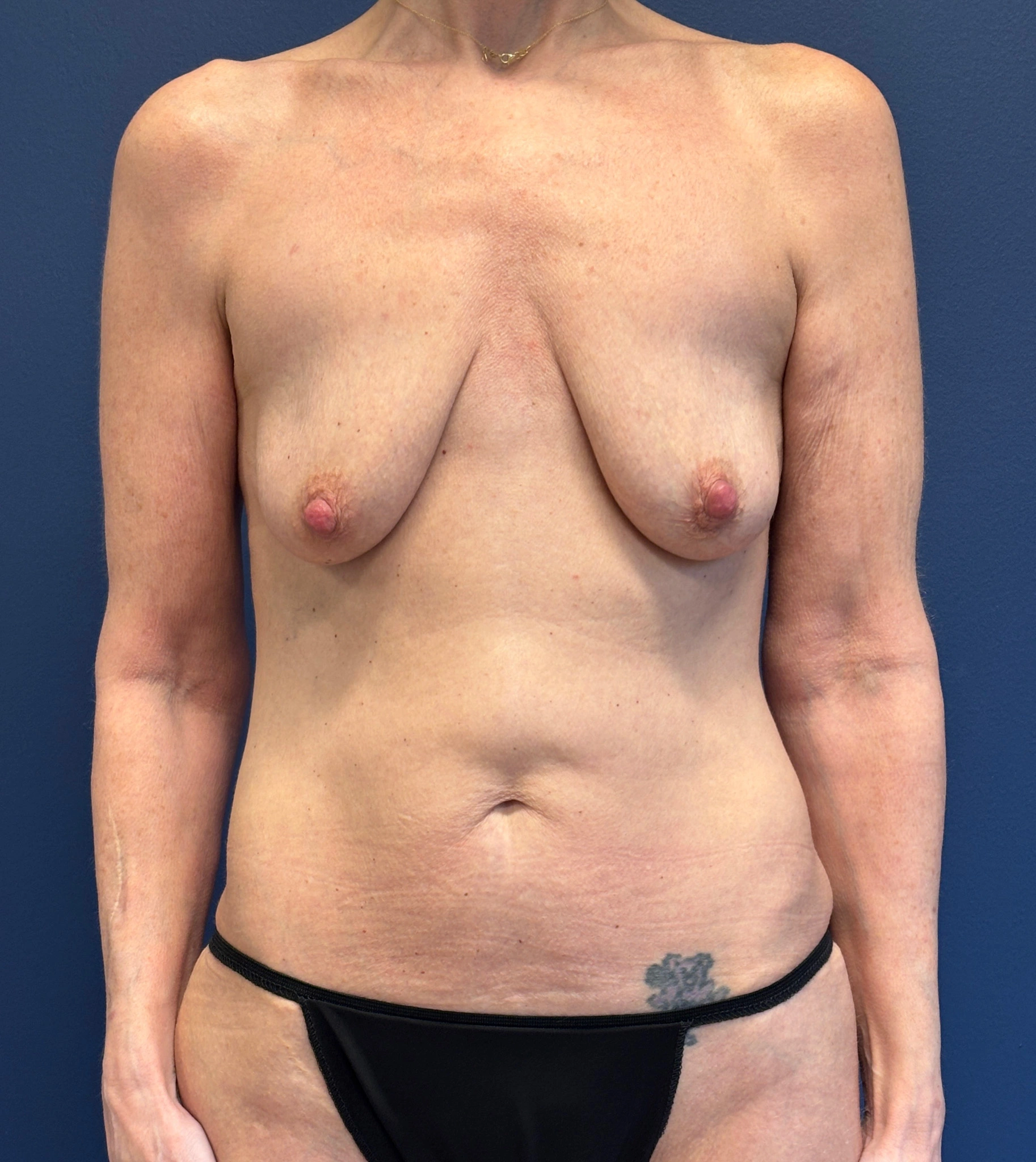 Augmentation-Mastopexy-Case--7491 | Before Breast Augmentation With Lift 1