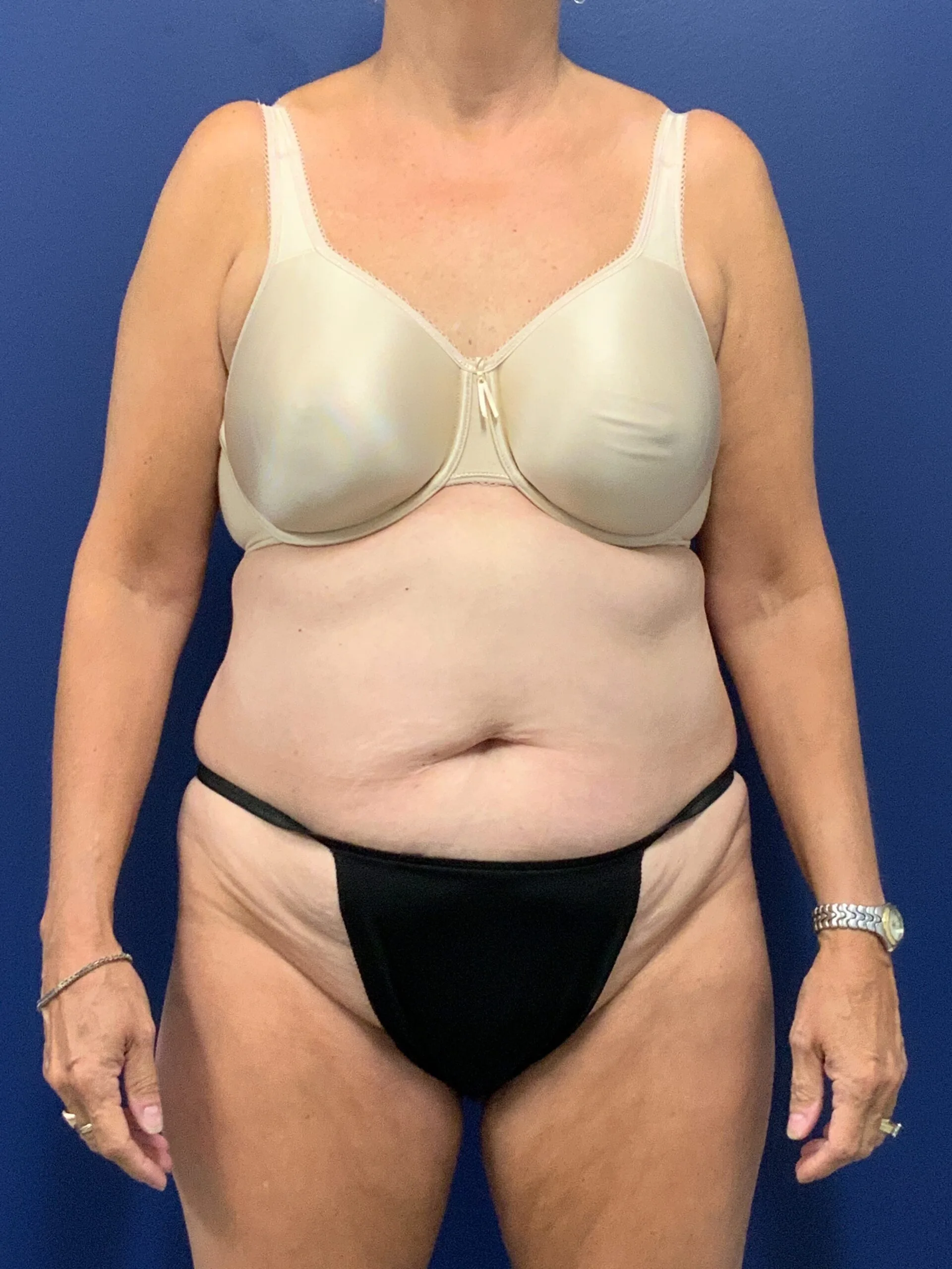 Abdominoplasty-Case--7963 | Before Body 1