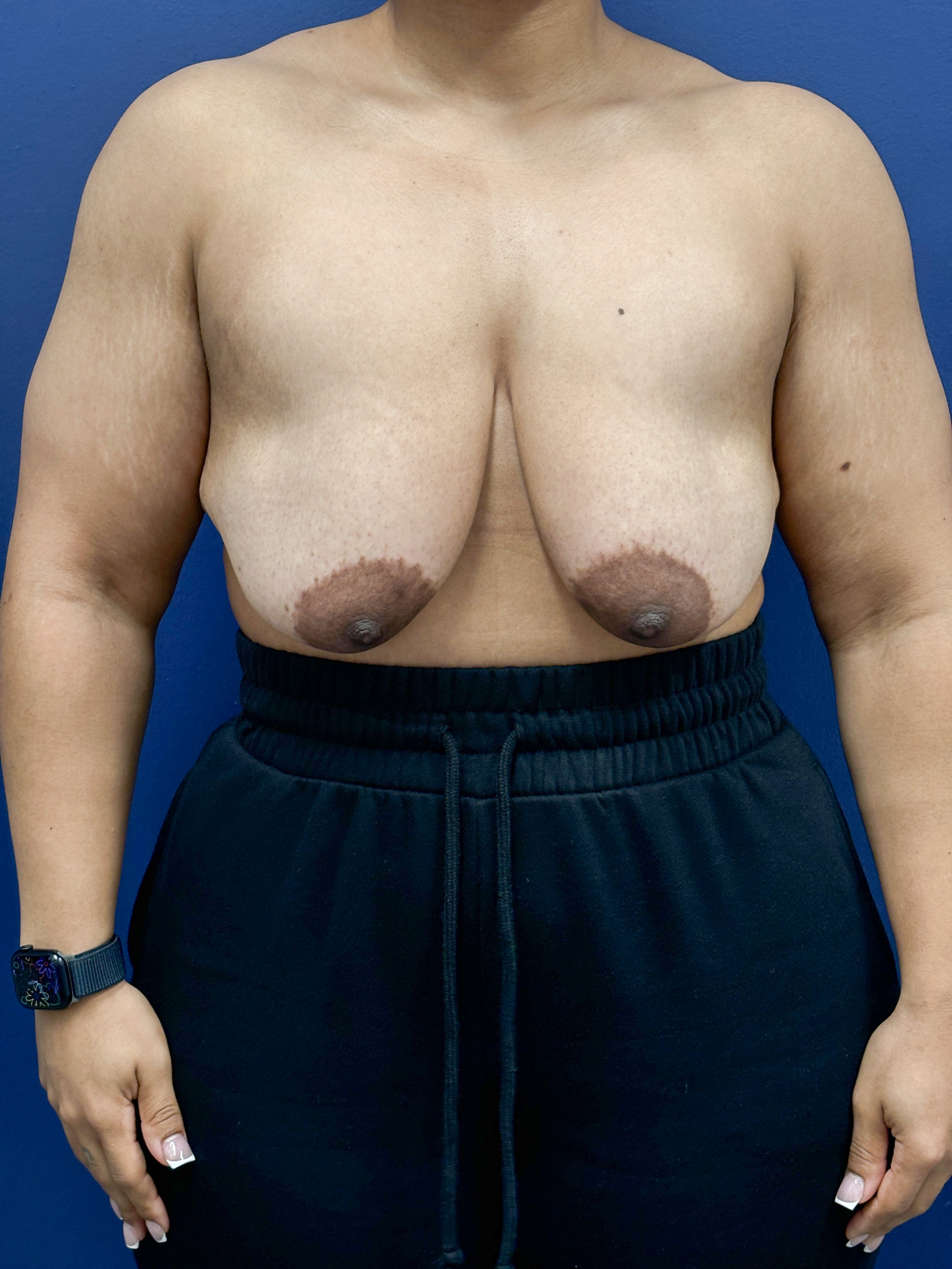 Breast-Reduction-Case--7345 | Before Breast Reduction 1