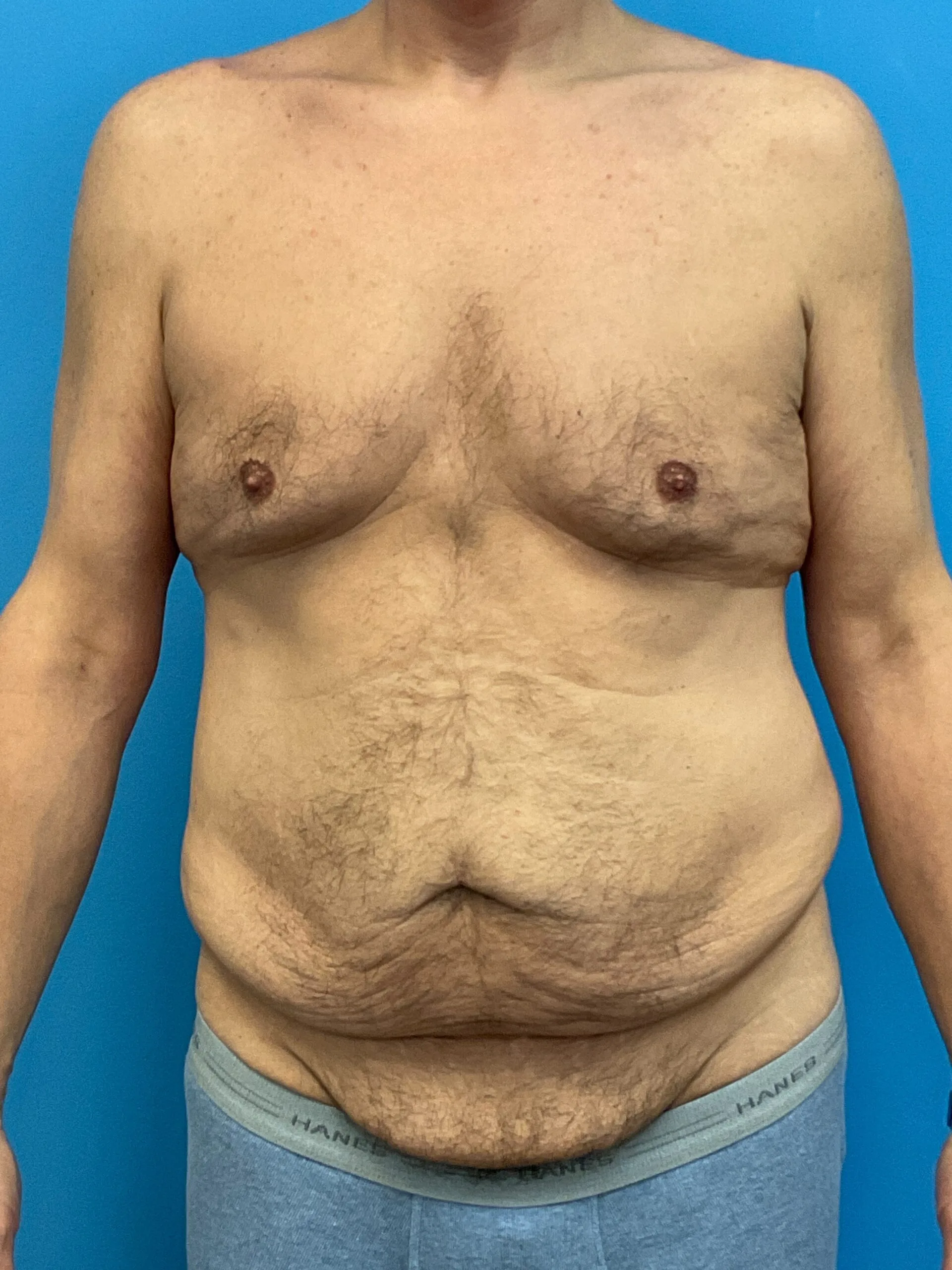 Abdominoplasty-Case--2524 | Before Body 1