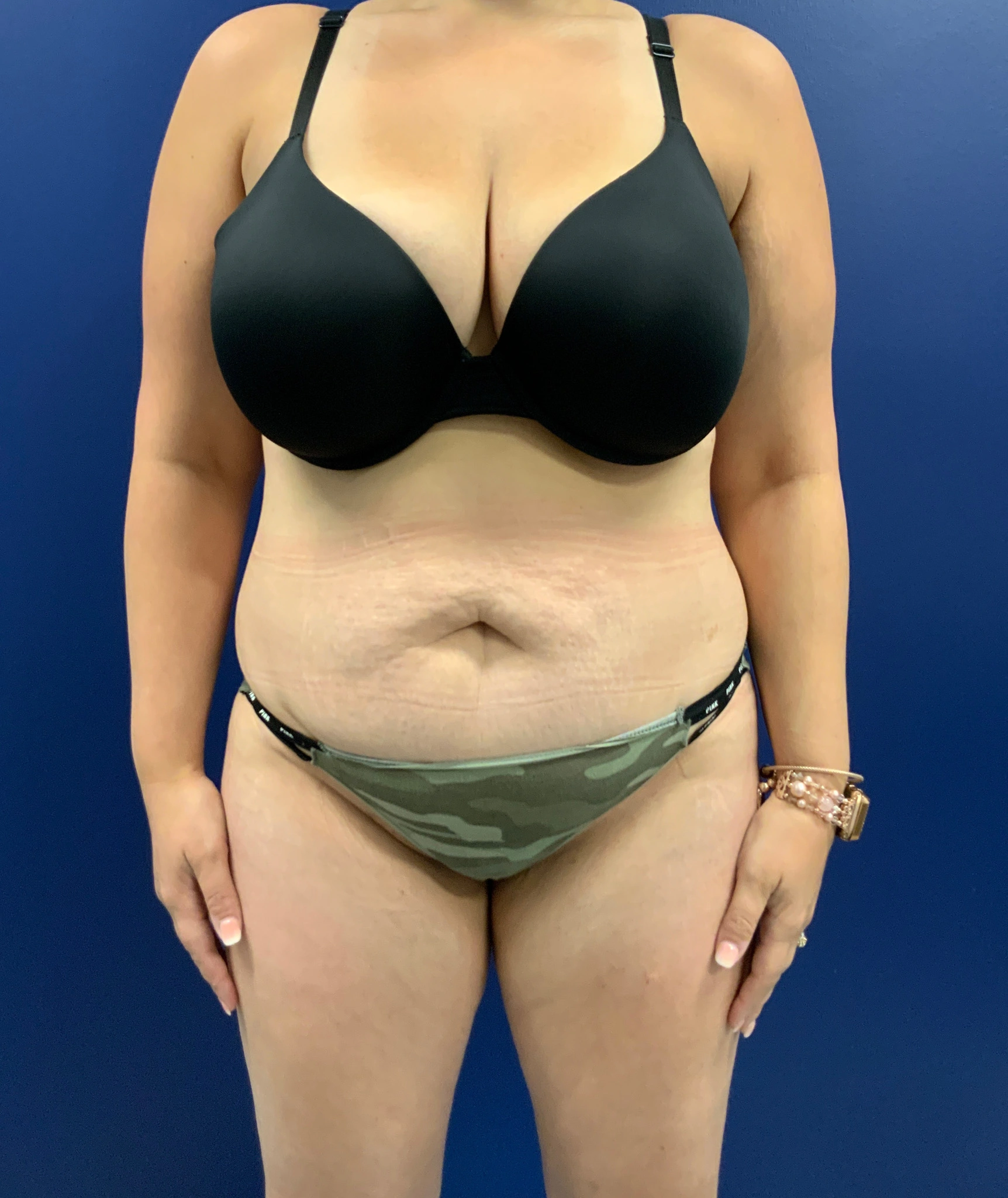 Abdominoplasty-Case--3073 | Before Body 1