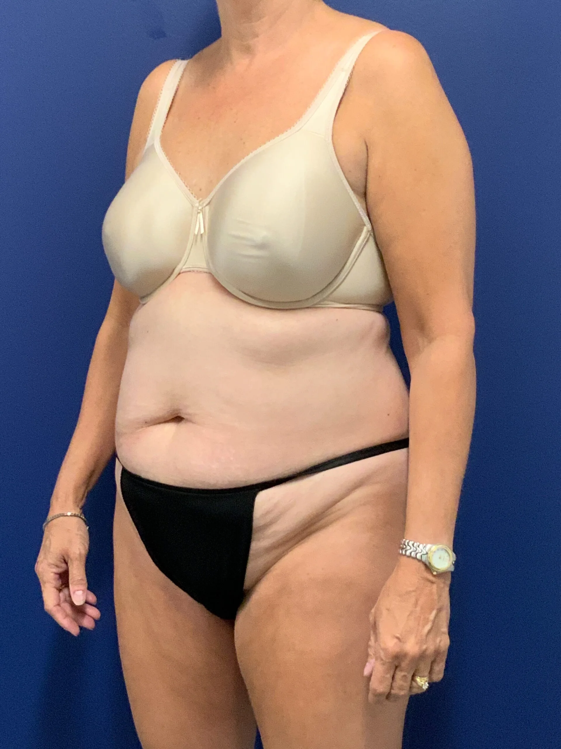 Abdominoplasty-Case--7963 | Before Body 2