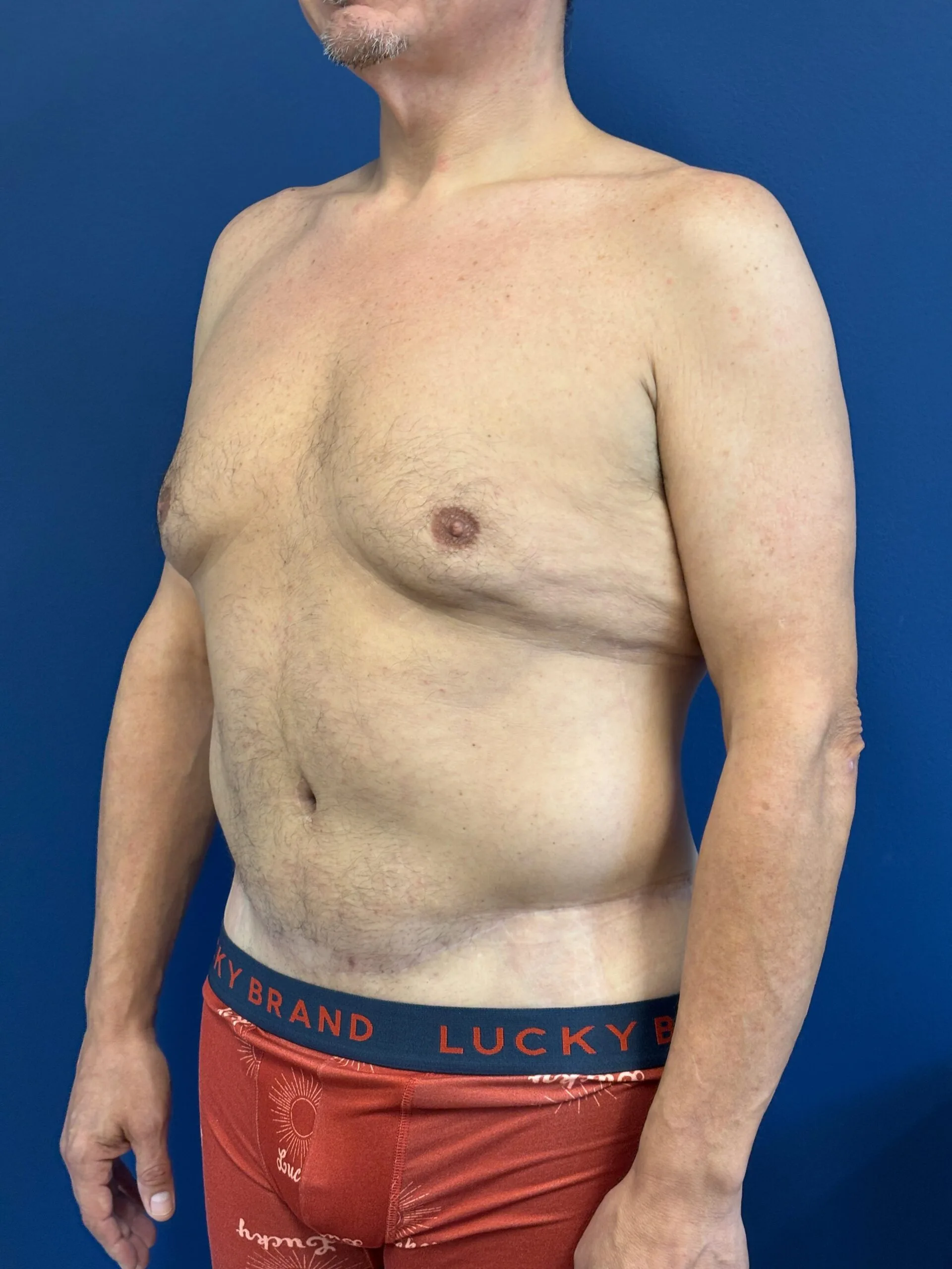 Abdominoplasty-Case--2524 | After Body 2