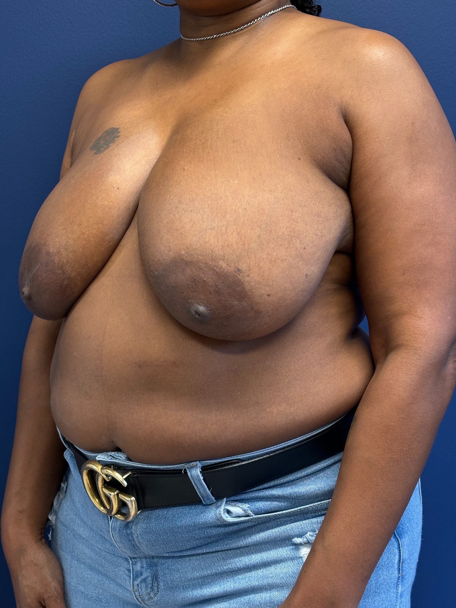 Breast-Reduction-Case--4053 | Before Breast Reduction 2