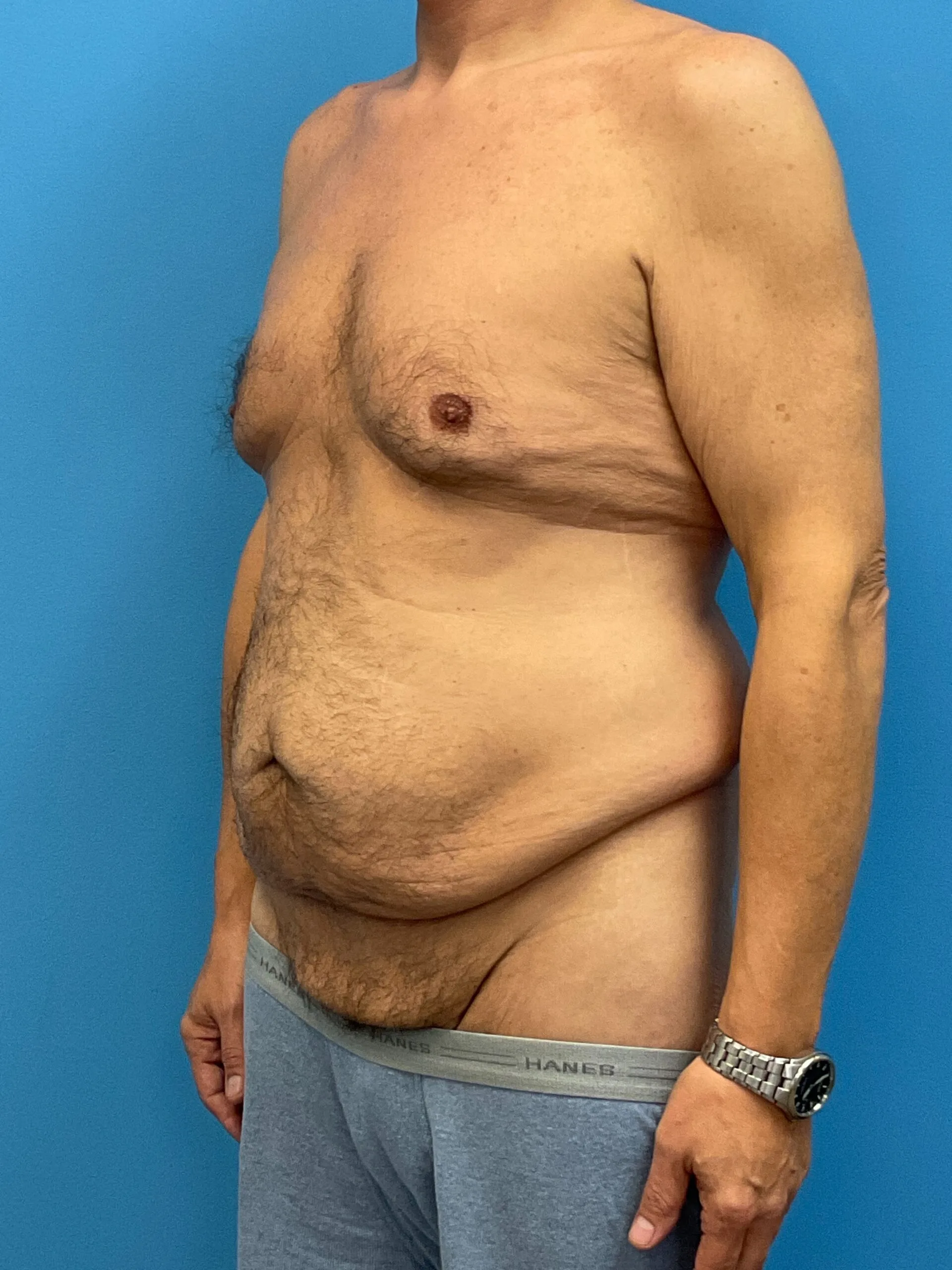 Abdominoplasty-Case--2524 | Before Body 2