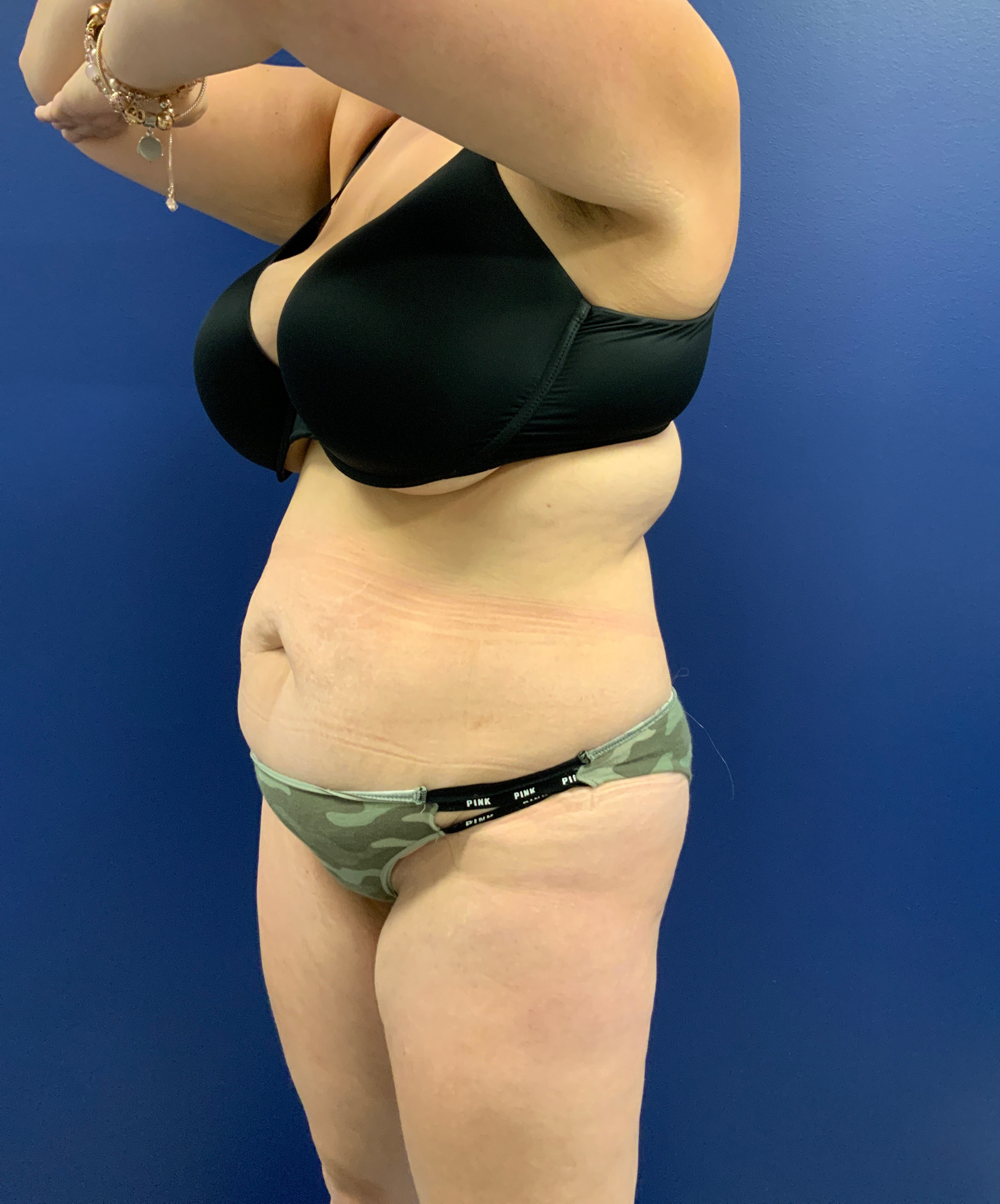 Abdominoplasty-Case--3073 | Before Body 2