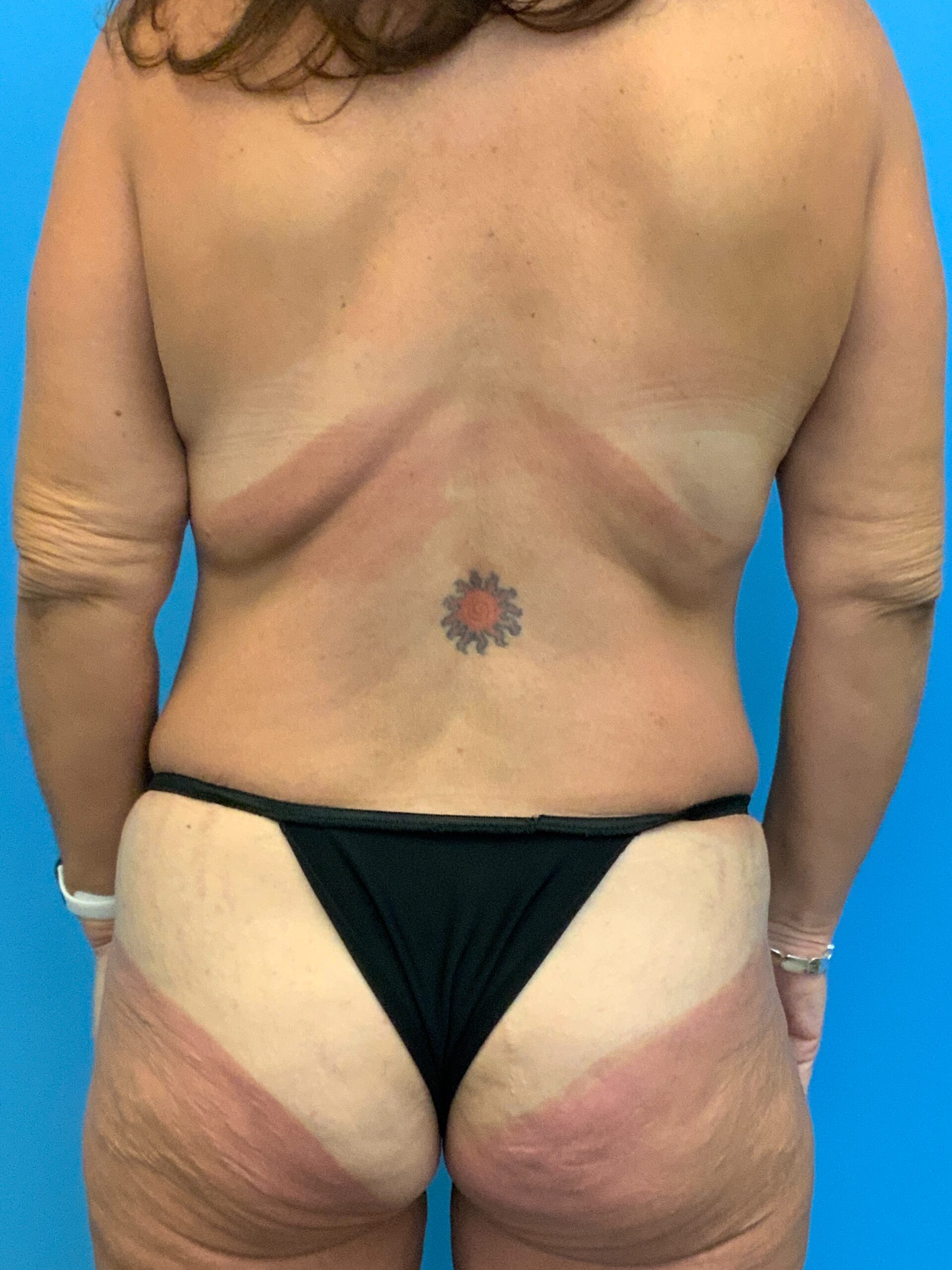 Abdominoplasty-Case--7009 | Before Tummy Tuck 6